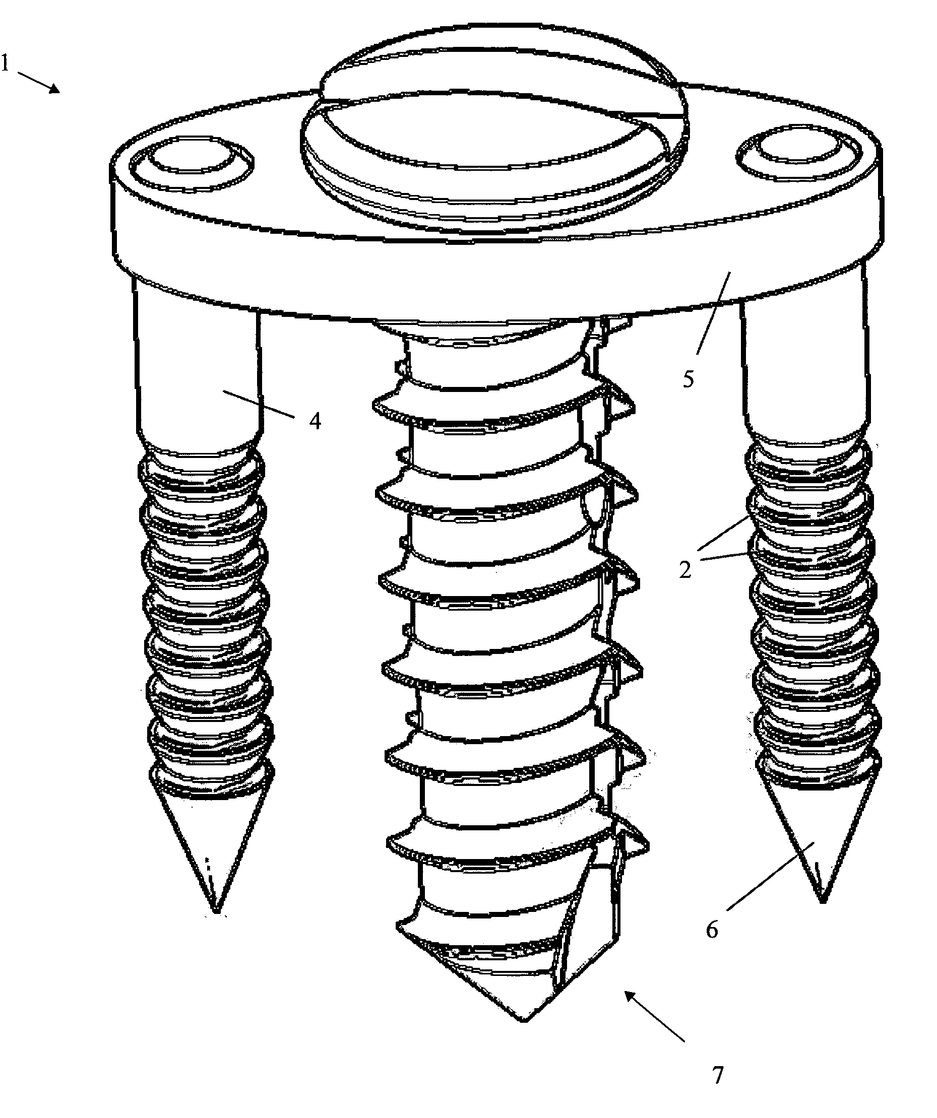 Method of lateral facet approach, decompression and fusion using screws and staples as well as arthroplasty