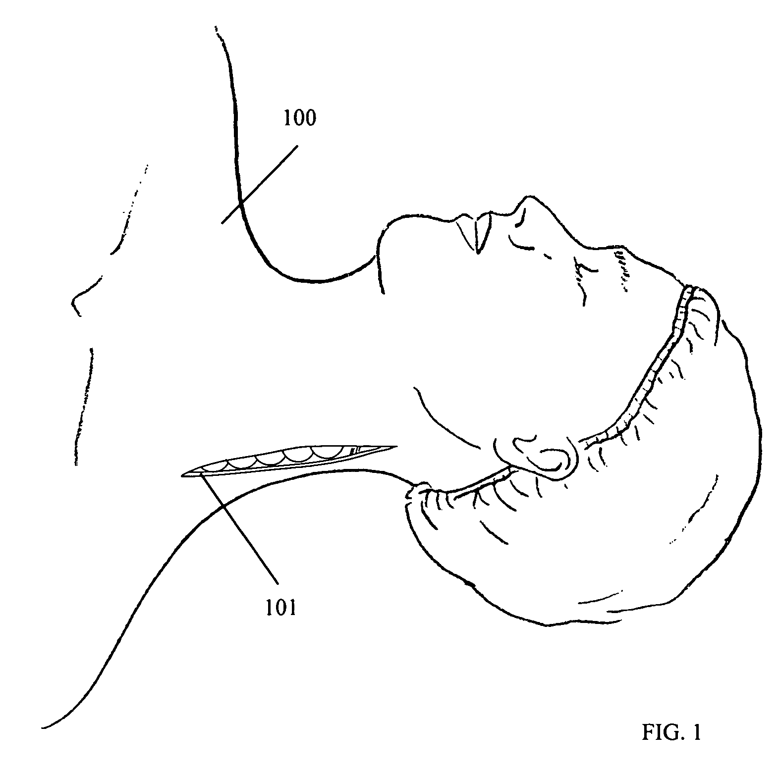 Method of lateral facet approach, decompression and fusion using screws and staples as well as arthroplasty