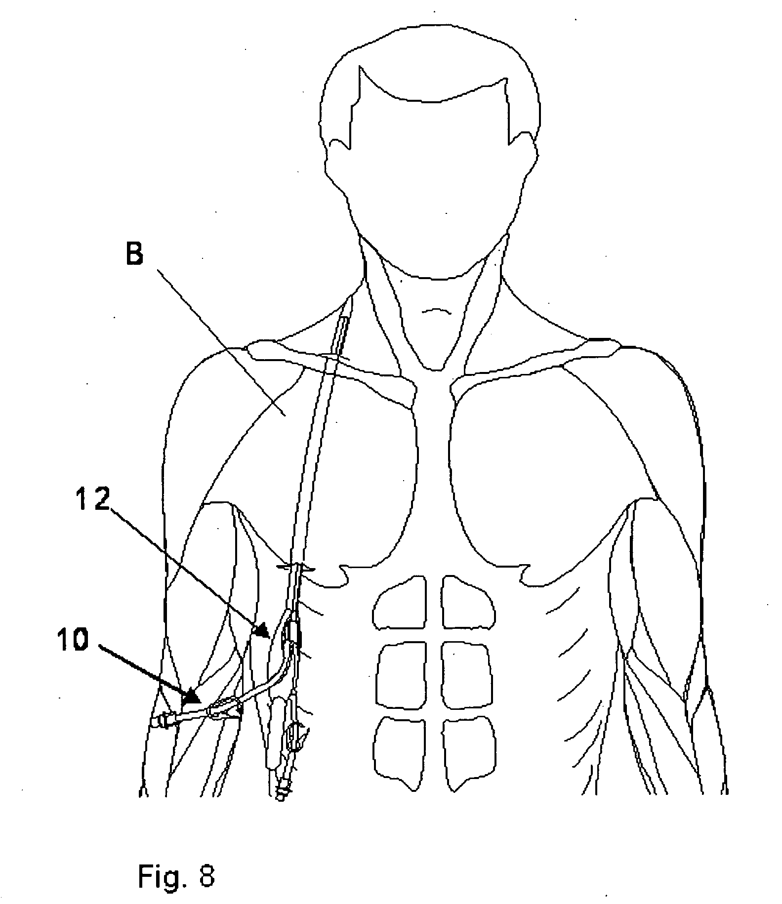 Catheter and Tunneling Device Therefor