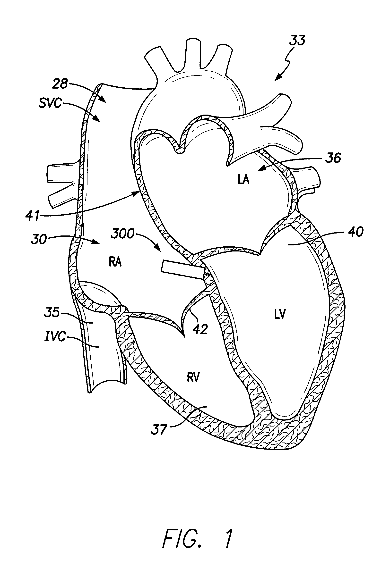 Single chamber leadless intra-cardiac medical device with dual-chamber functionality