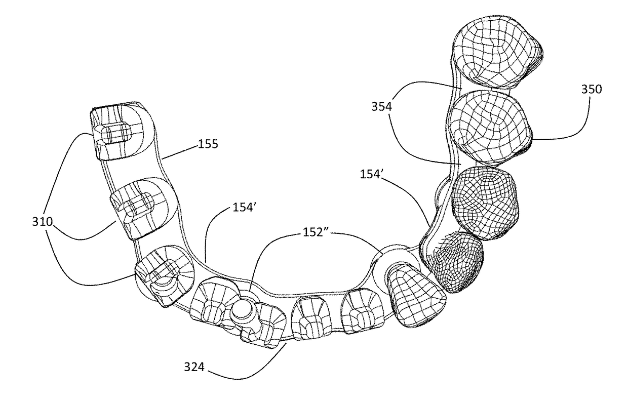 Dental Framework and Prosthesis