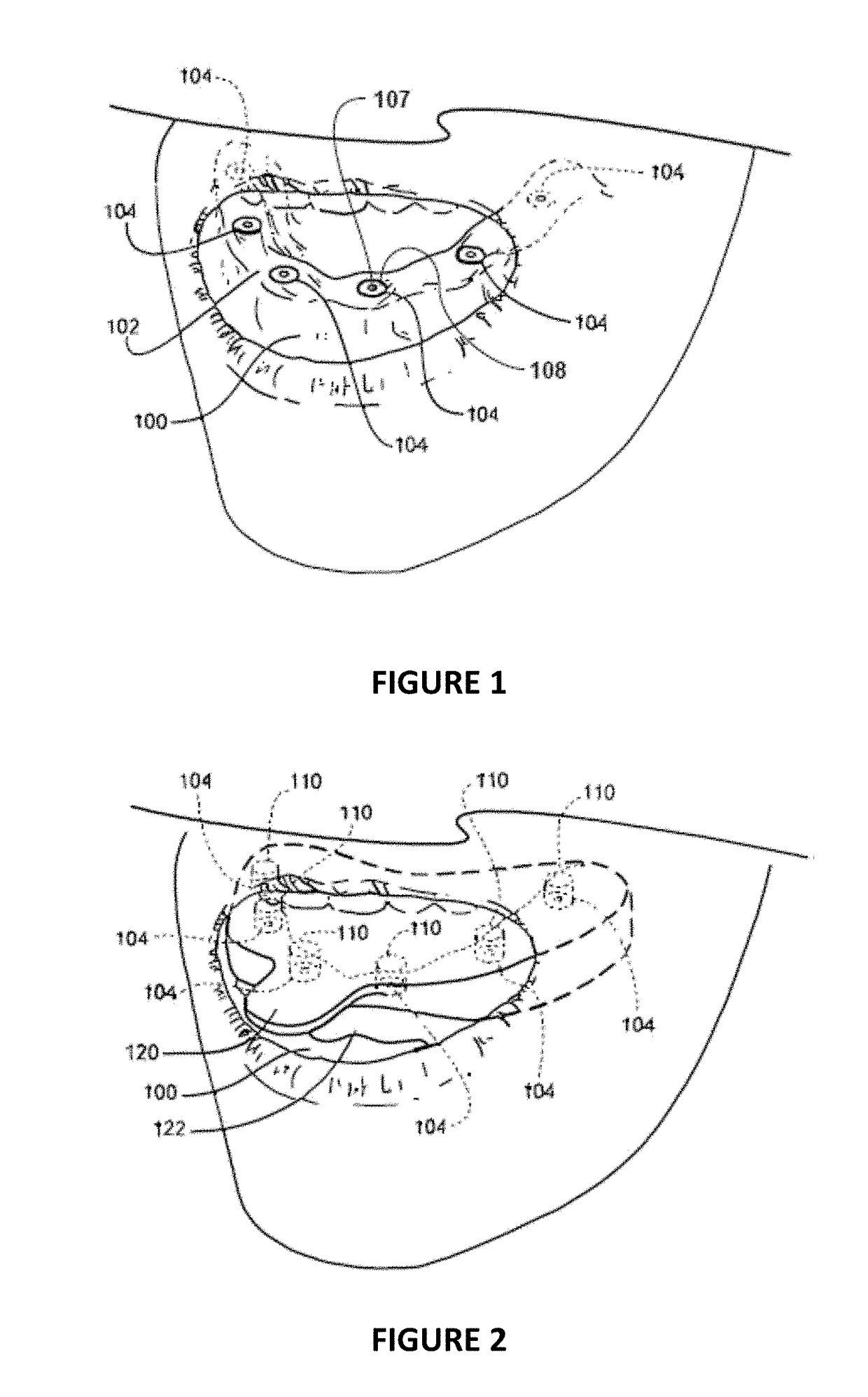 Dental Framework and Prosthesis