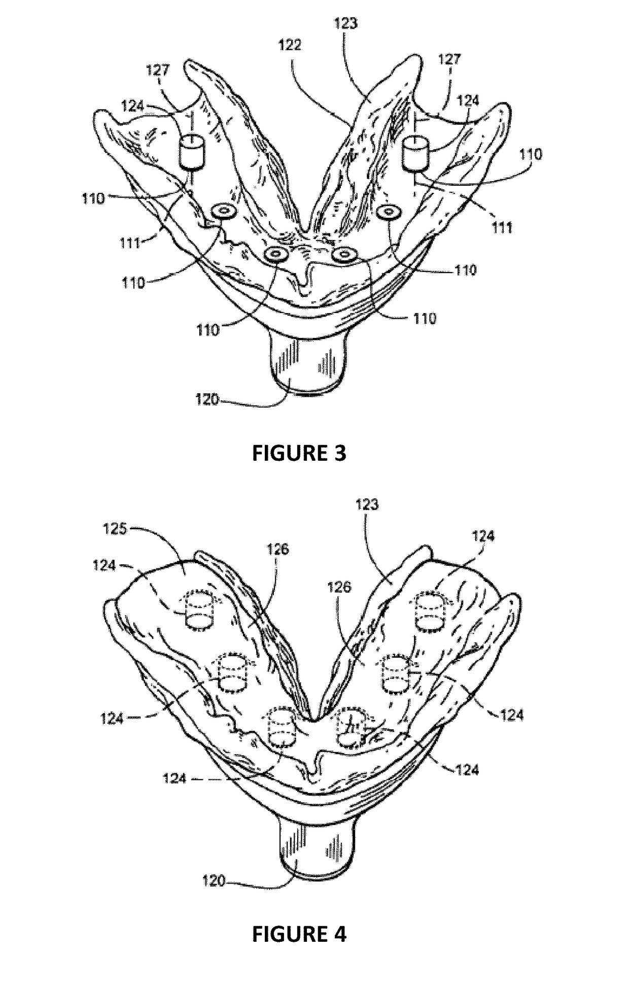 Dental Framework and Prosthesis