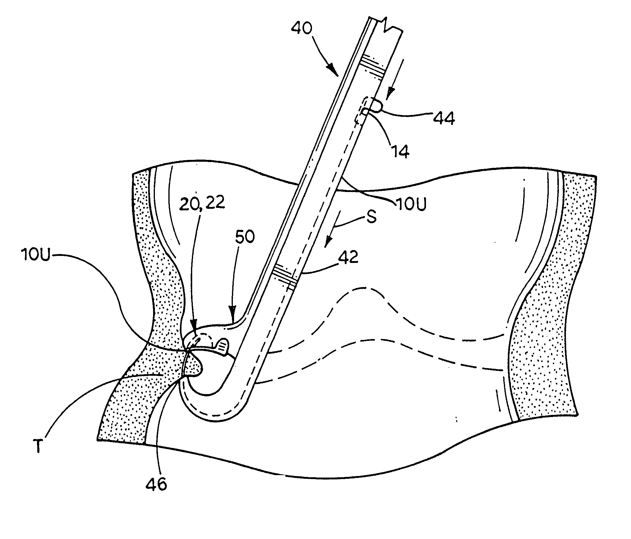 Extremely long wire fasteners for use in minimally invasive surgery and means and methods for handling those fasteners