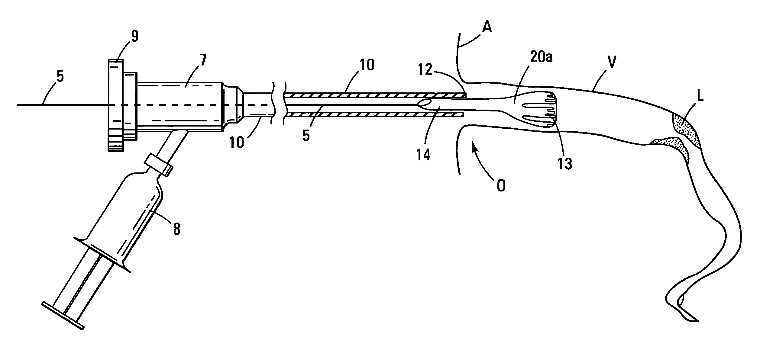 Device to create proximal stasis