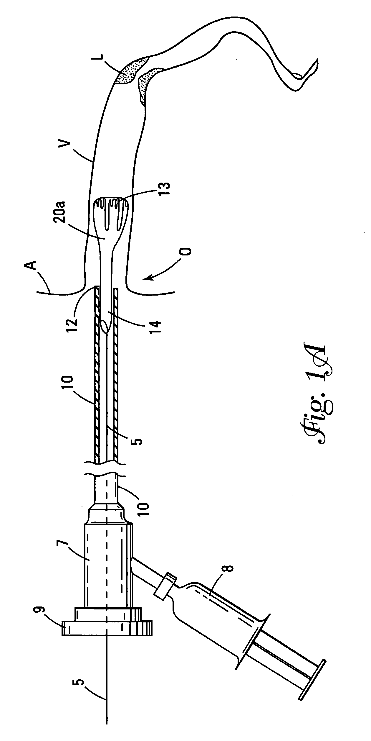 Device to create proximal stasis