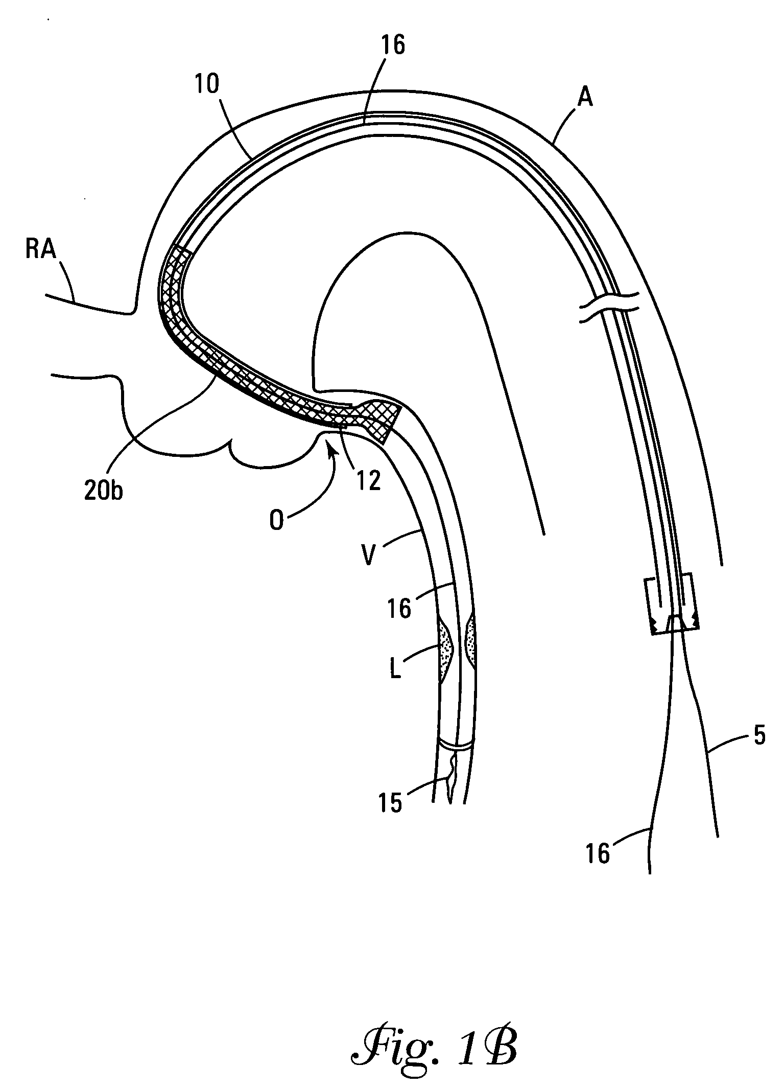 Device to create proximal stasis