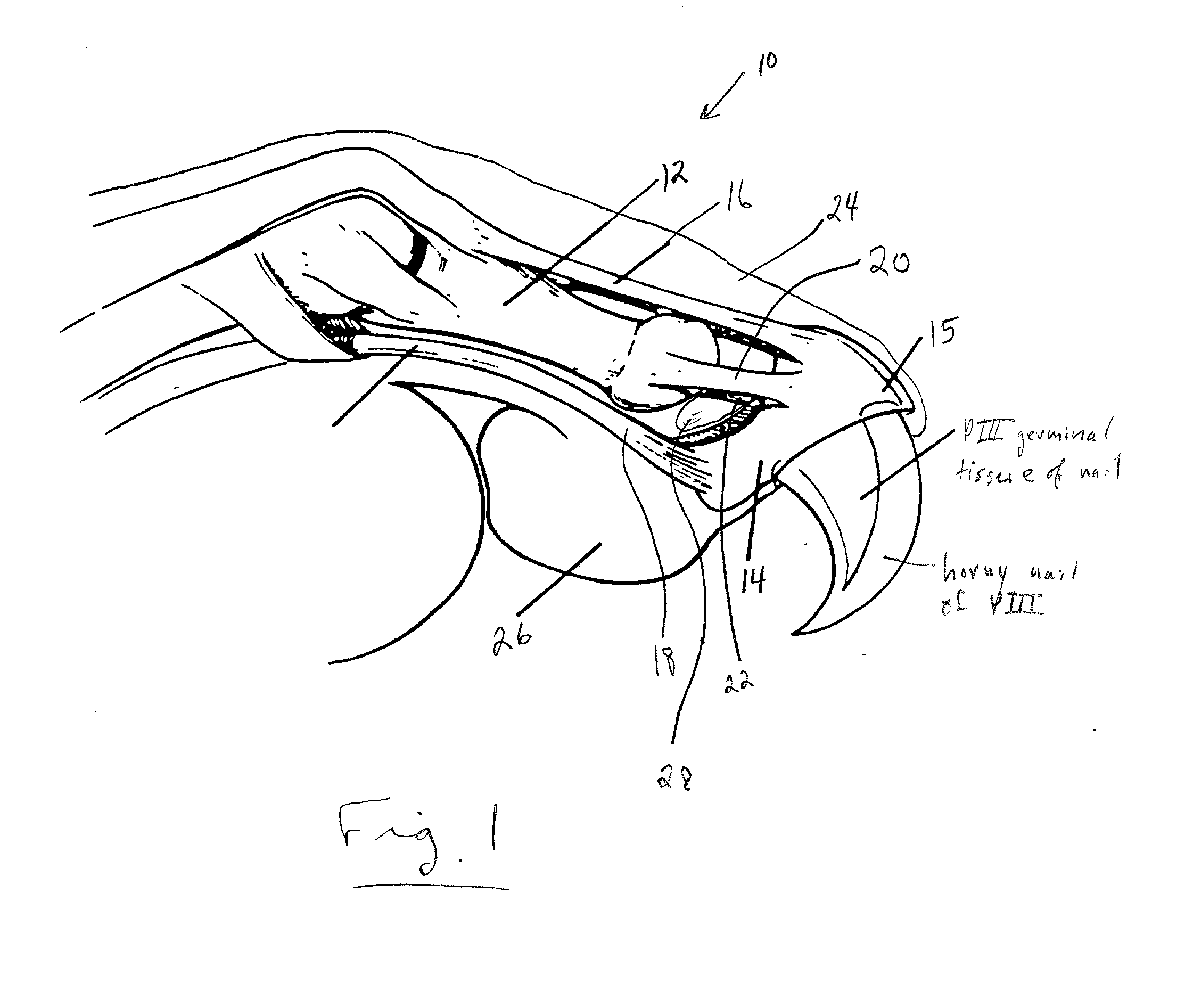 Laser onychectomy by resection of the redundant epithelium of the ungual crest