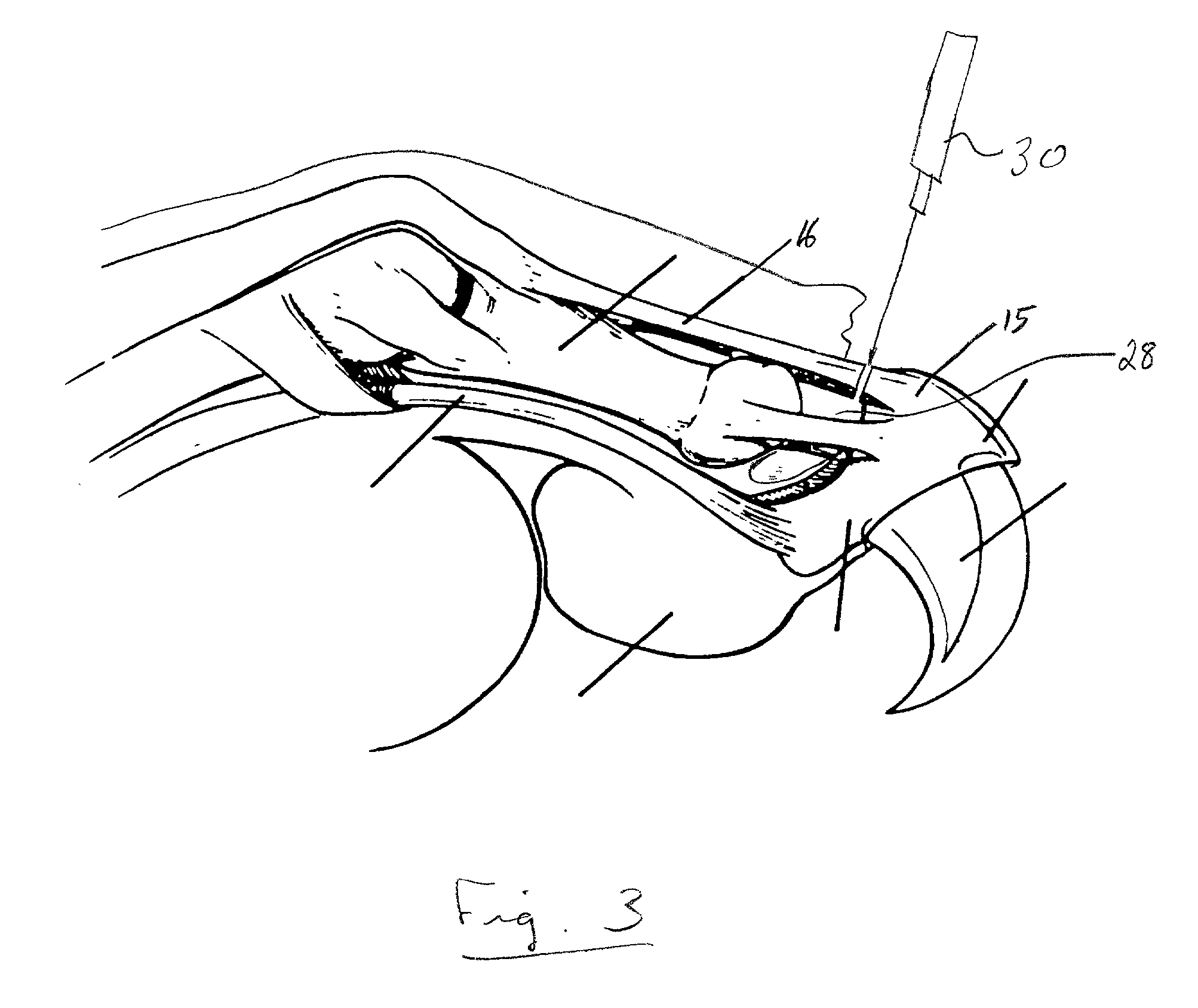 Laser onychectomy by resection of the redundant epithelium of the ungual crest