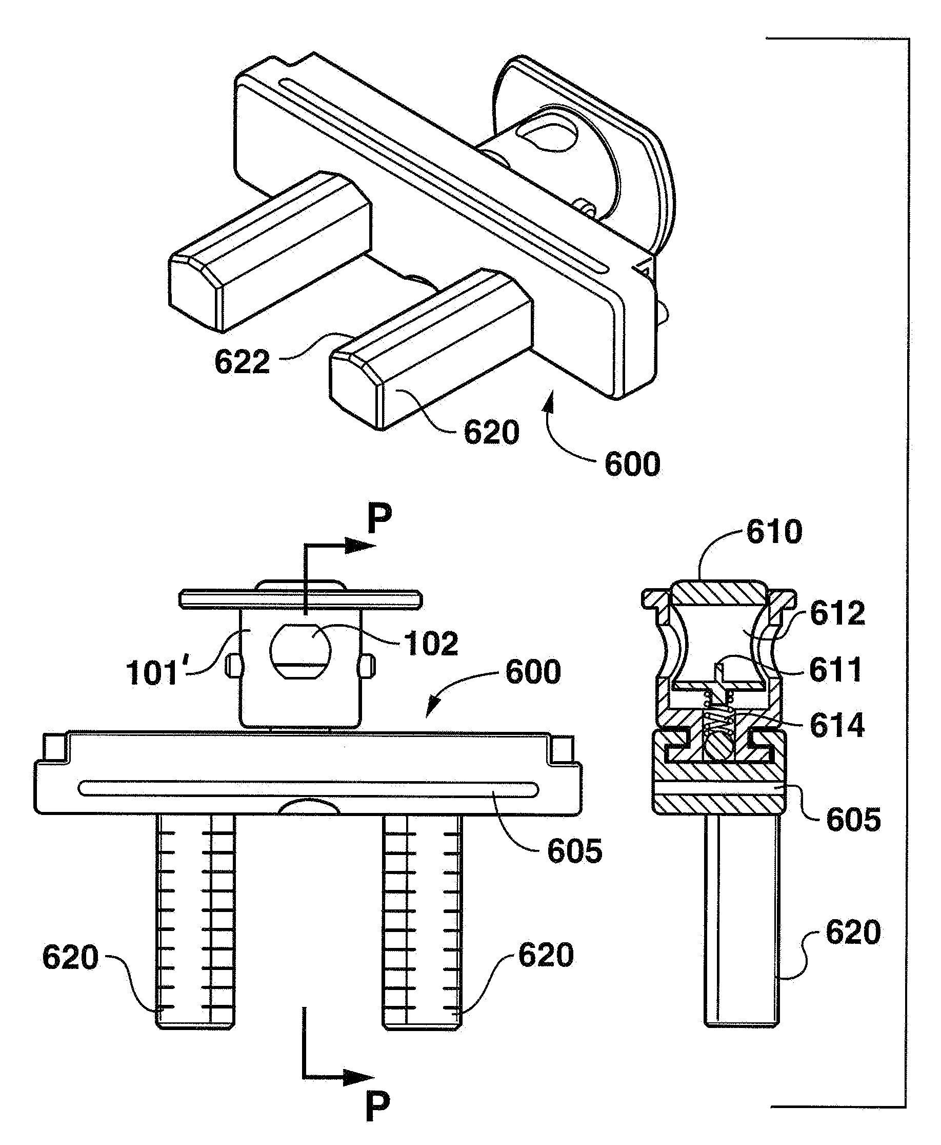 Instruments for minimally invasive surgery total knee arthroplasty