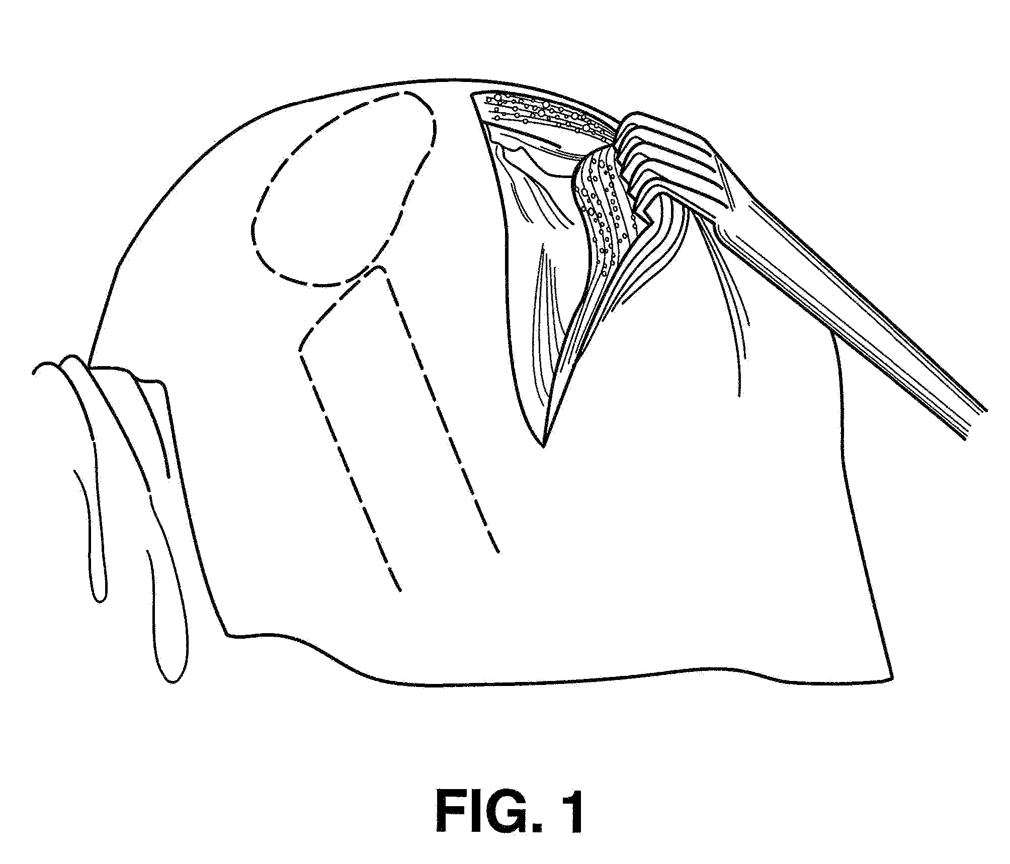 Instruments for minimally invasive surgery total knee arthroplasty