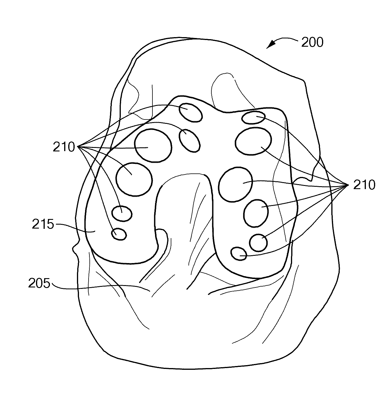 Methods and Devices For Quantitative Analysis of Bone and Cartilage Defects