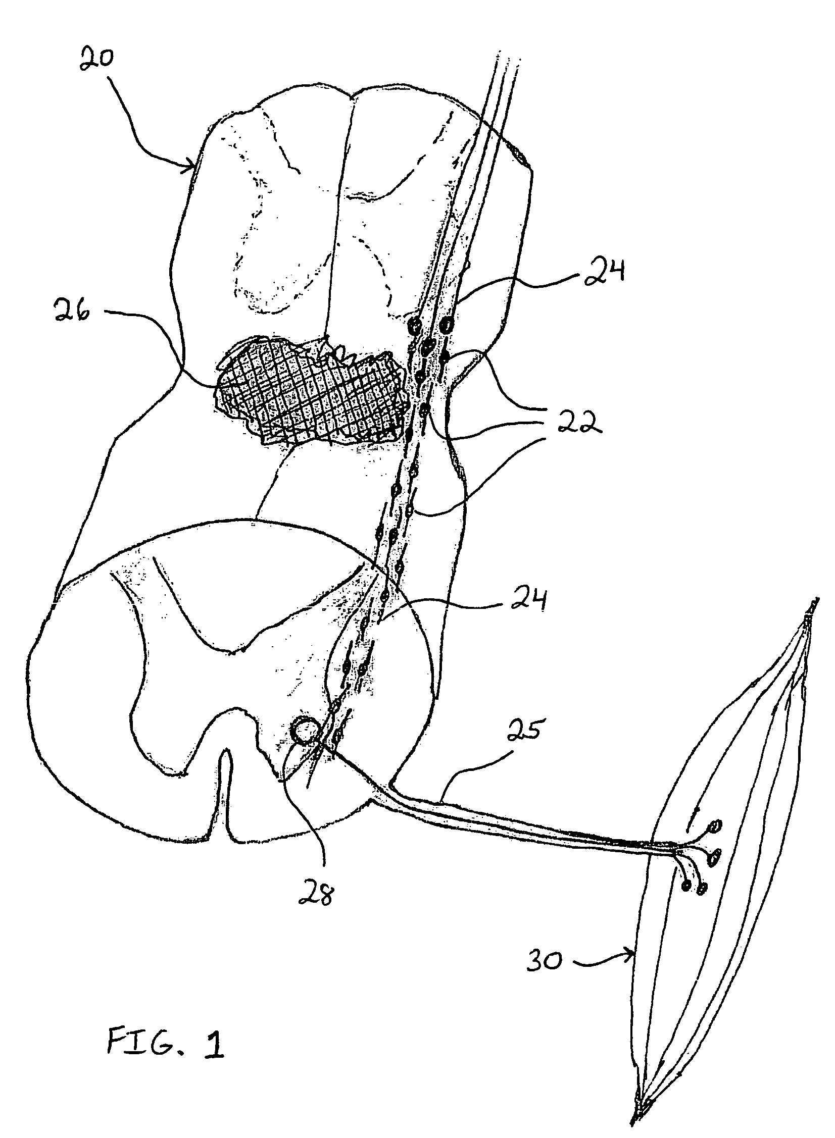 Method and system for cellular transplantation in the spinal cord