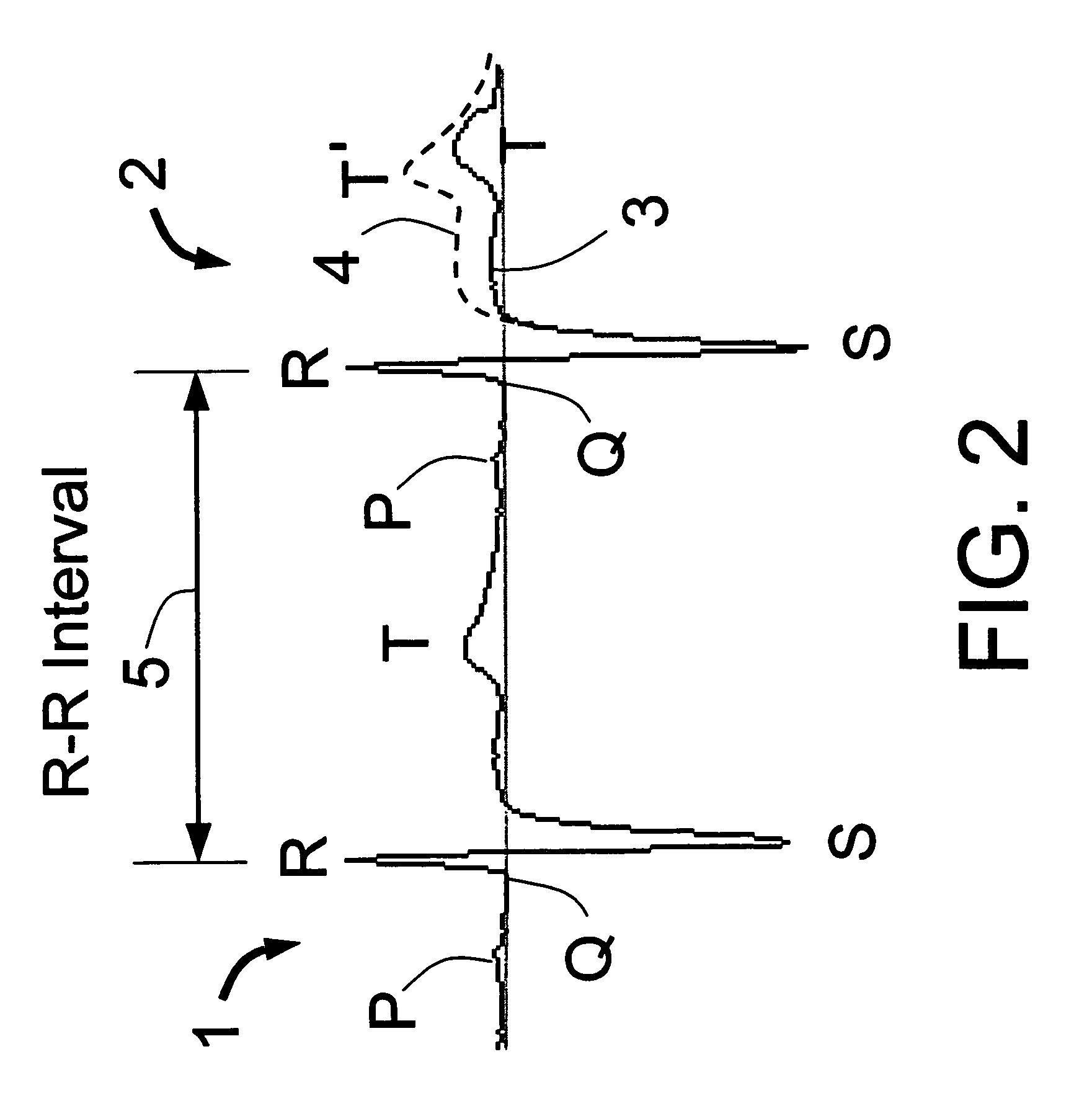 Means and method for the detection of cardiac events