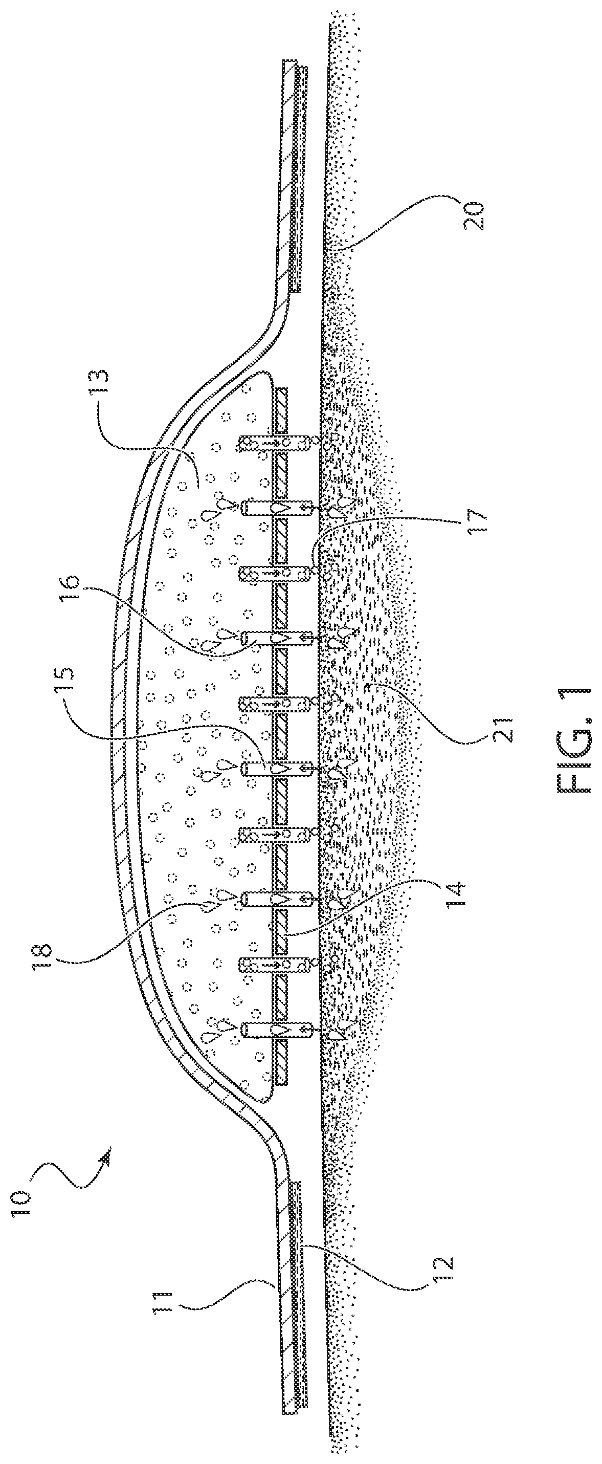 Bandage with UV disinfectant and microneedles for antimicrobial delivery and fluid absorption from a wound