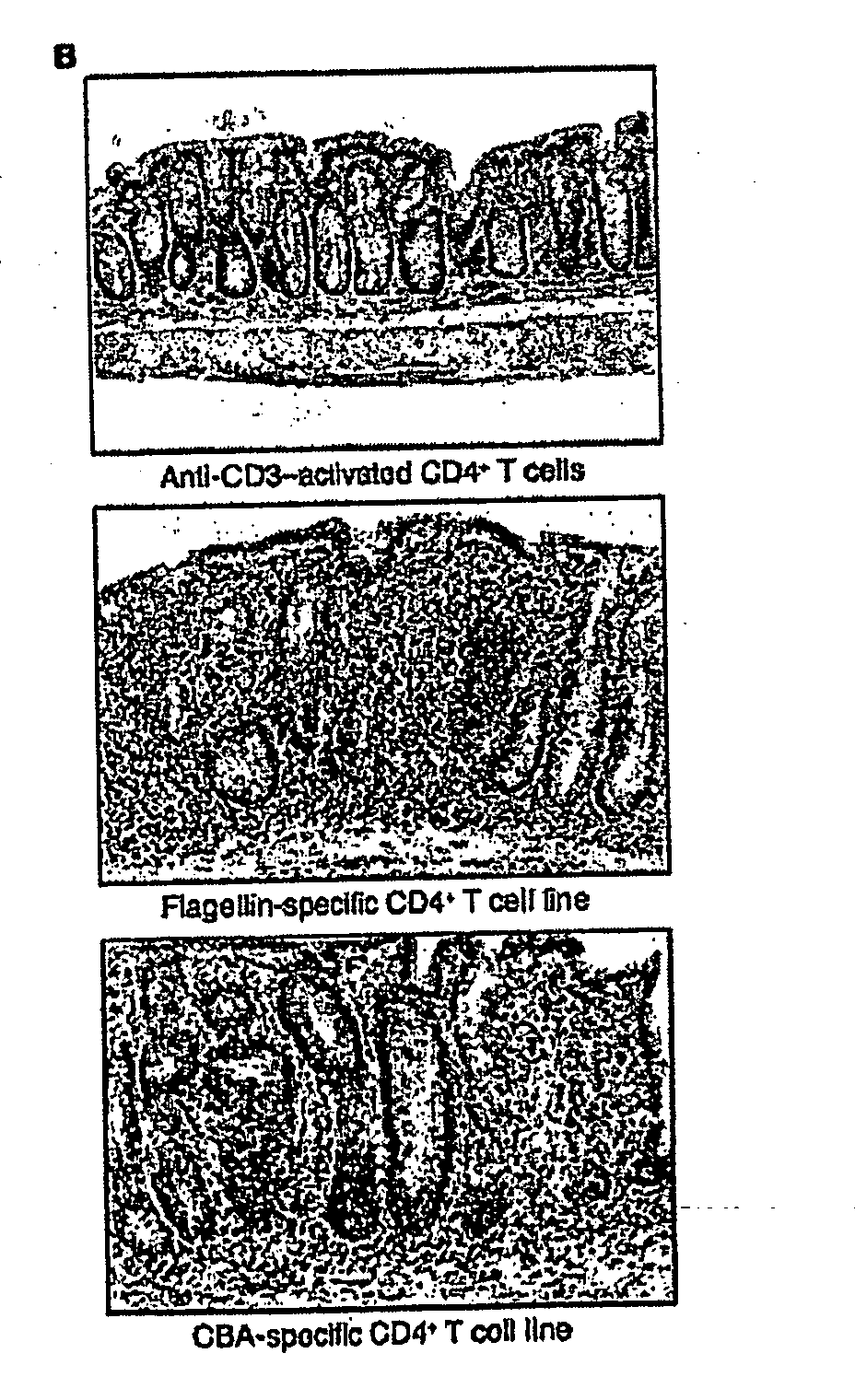 Methods for diagnosis and treatment of crohn's disease