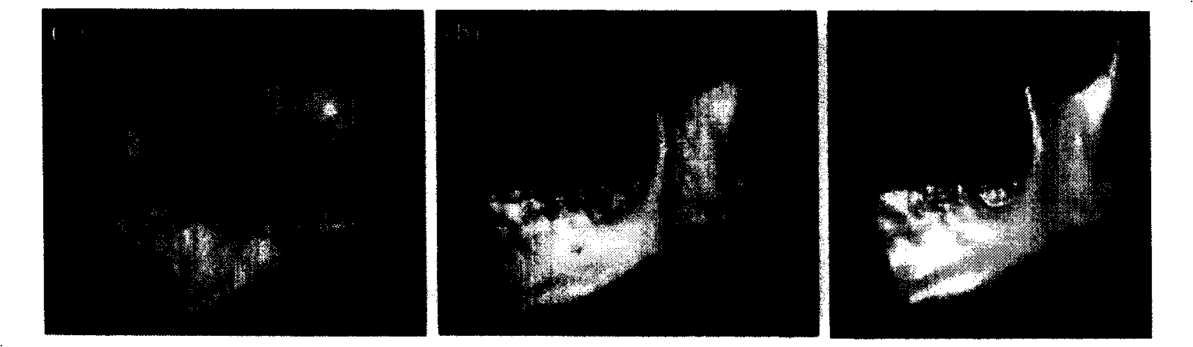 Titanium individuation mandibula prosthesis and preparation