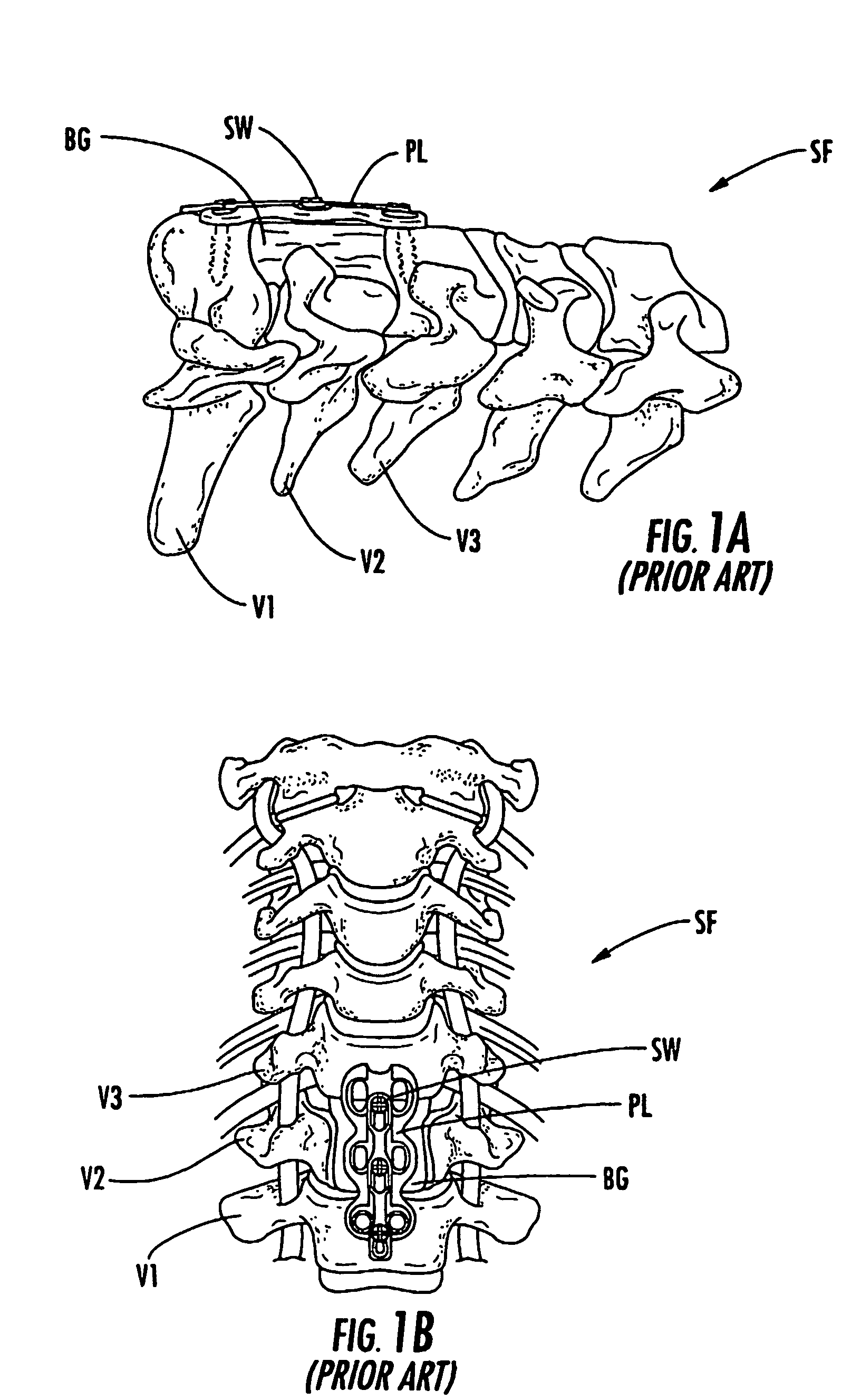 Spine replacement system for the treatment of spine instability and degenerative disc disease