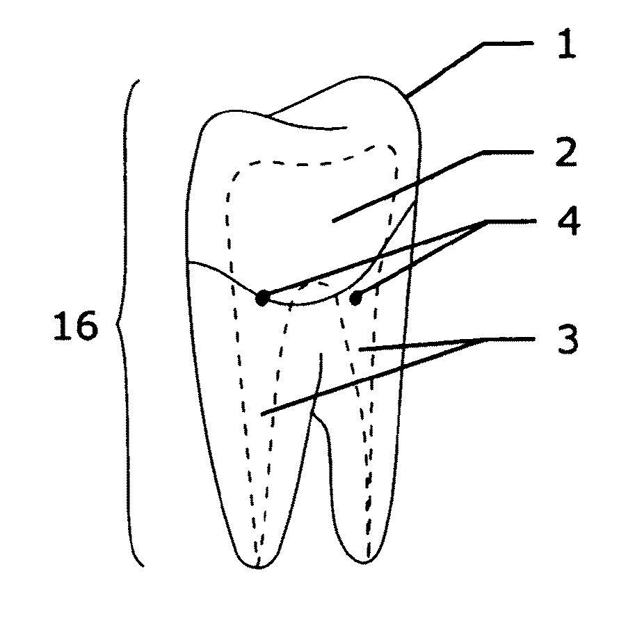 Method and system for establishing the shape of the occlusal access cavity in endodontic treatment