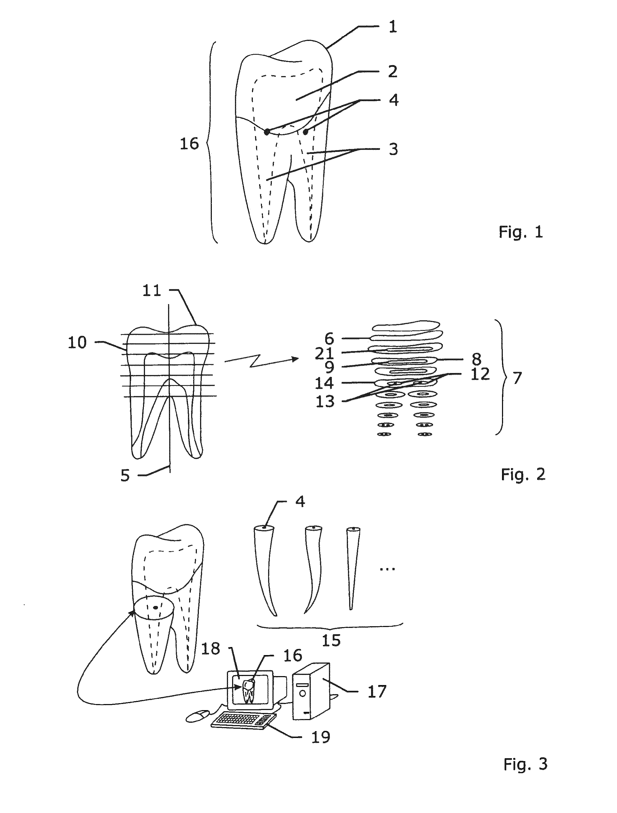 Method and system for establishing the shape of the occlusal access cavity in endodontic treatment