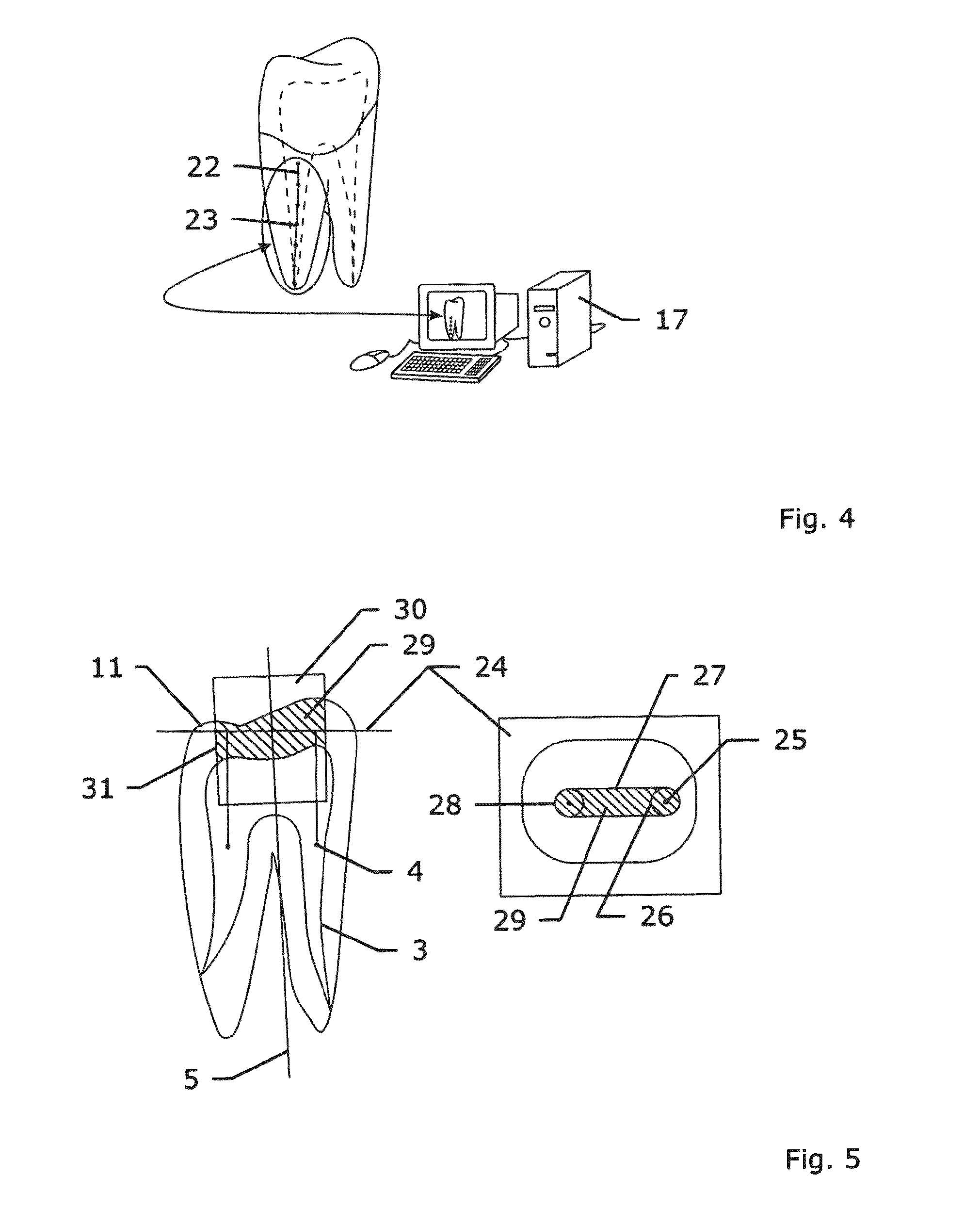 Method and system for establishing the shape of the occlusal access cavity in endodontic treatment