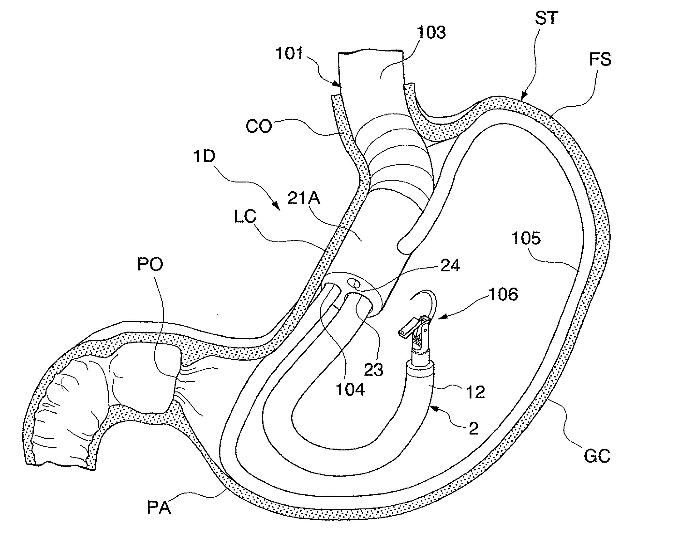 Gastric therapy system and method for suturing gastric wall