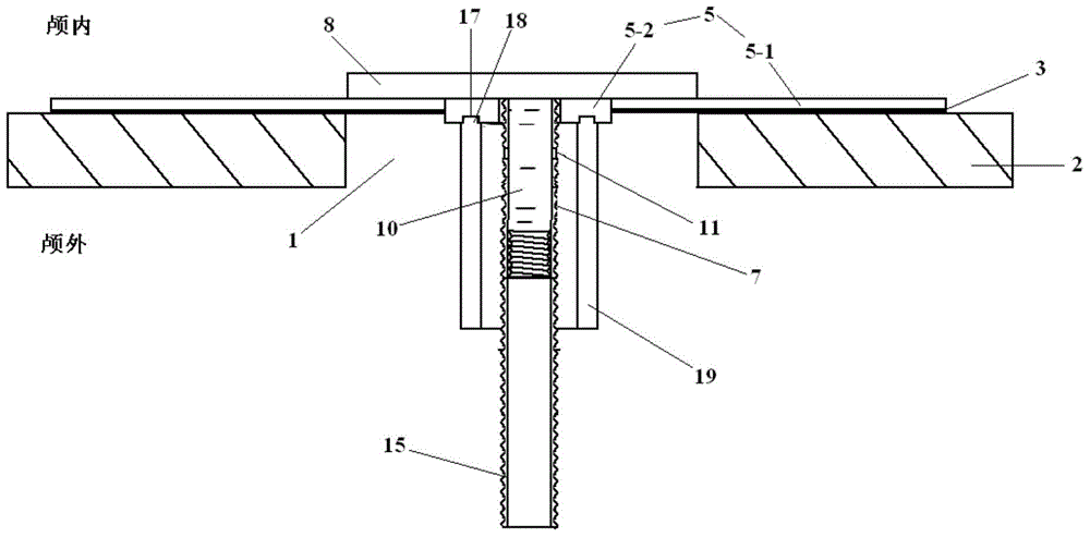 Device for repairing skull base defects