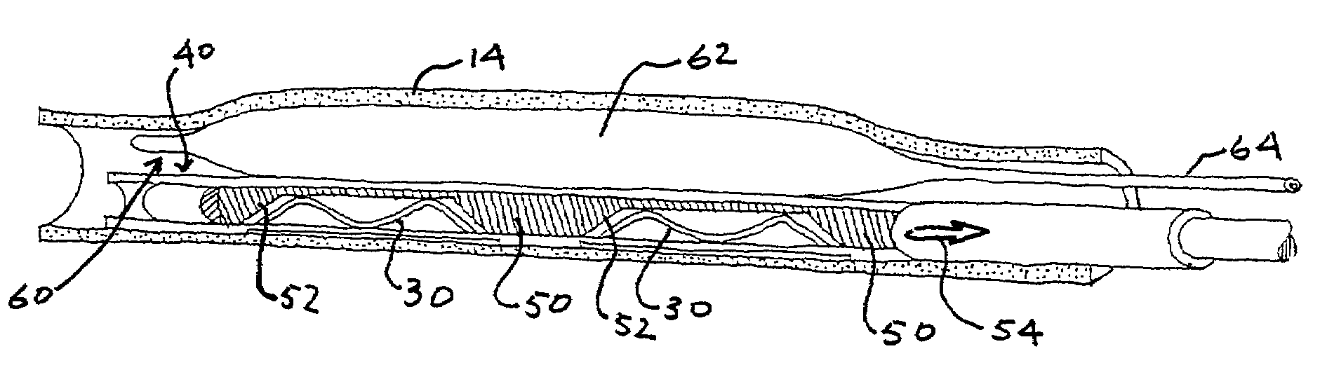 Transvenous staples, assembly and method for mitral valve repair