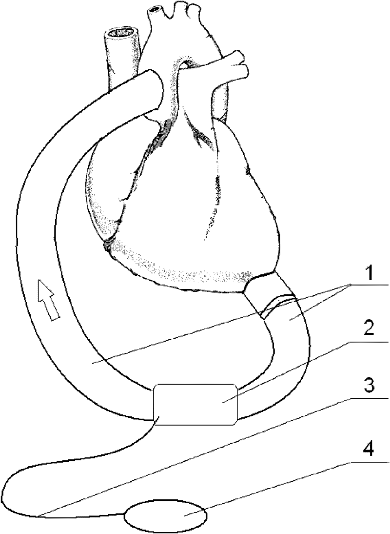 A left ventricular assist device