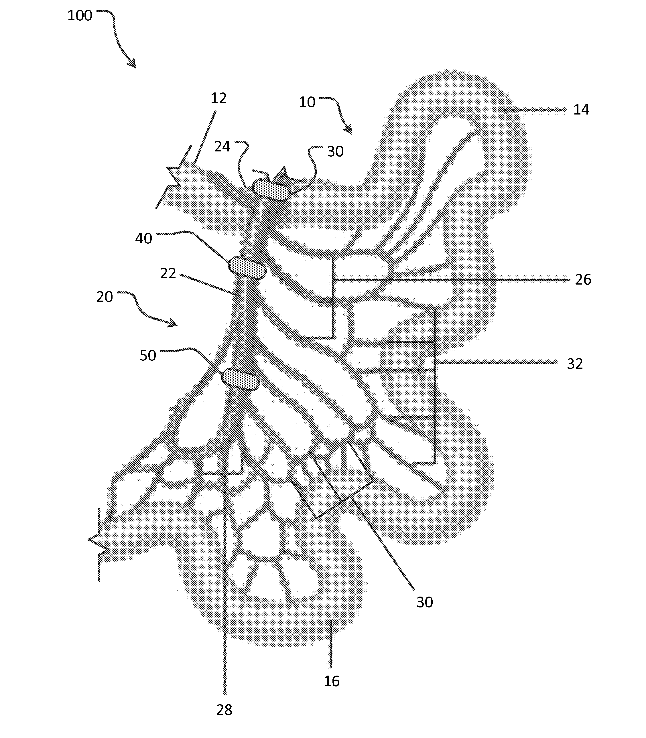 Arterial constrictor for weight loss treatment