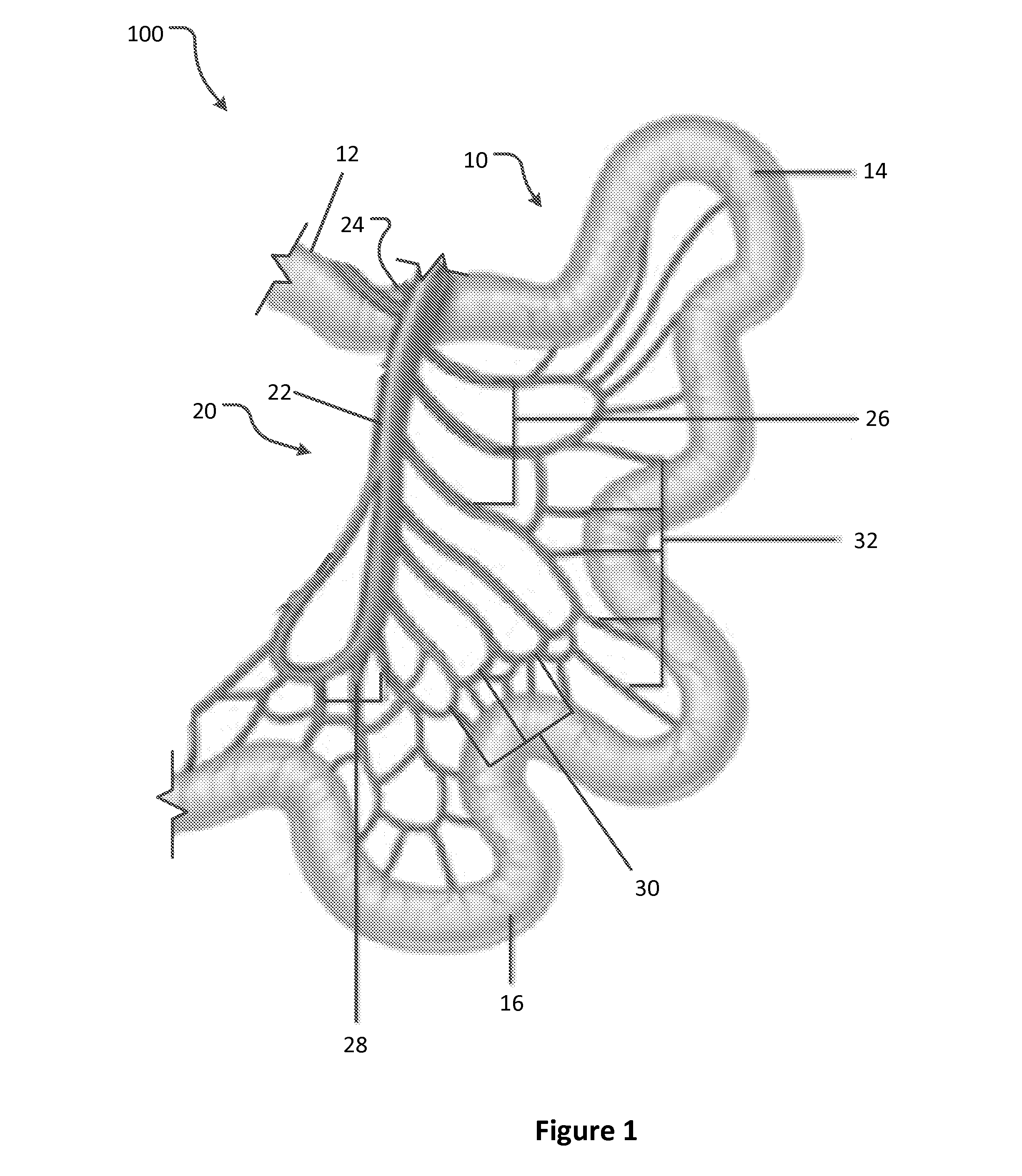 Arterial constrictor for weight loss treatment