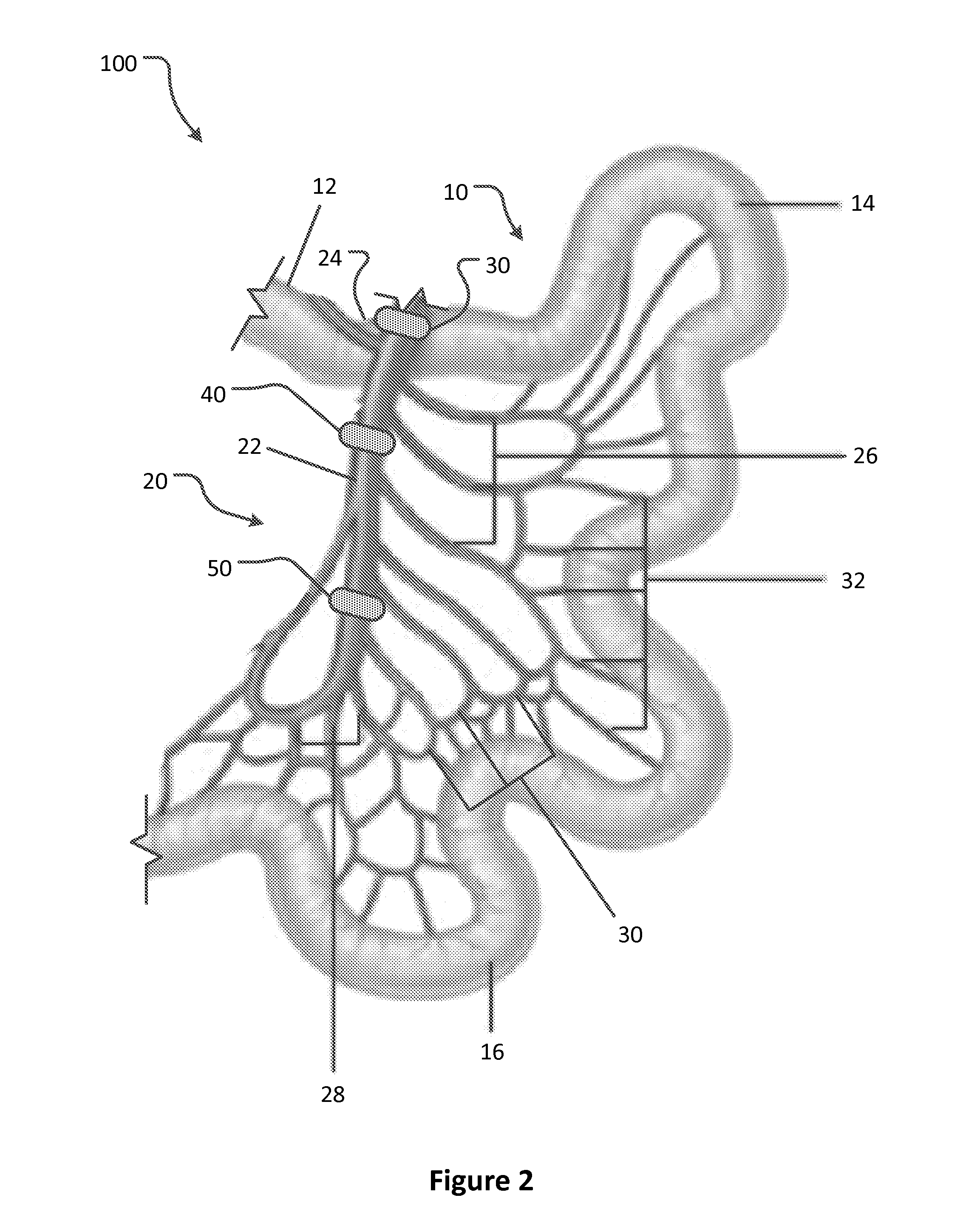 Arterial constrictor for weight loss treatment