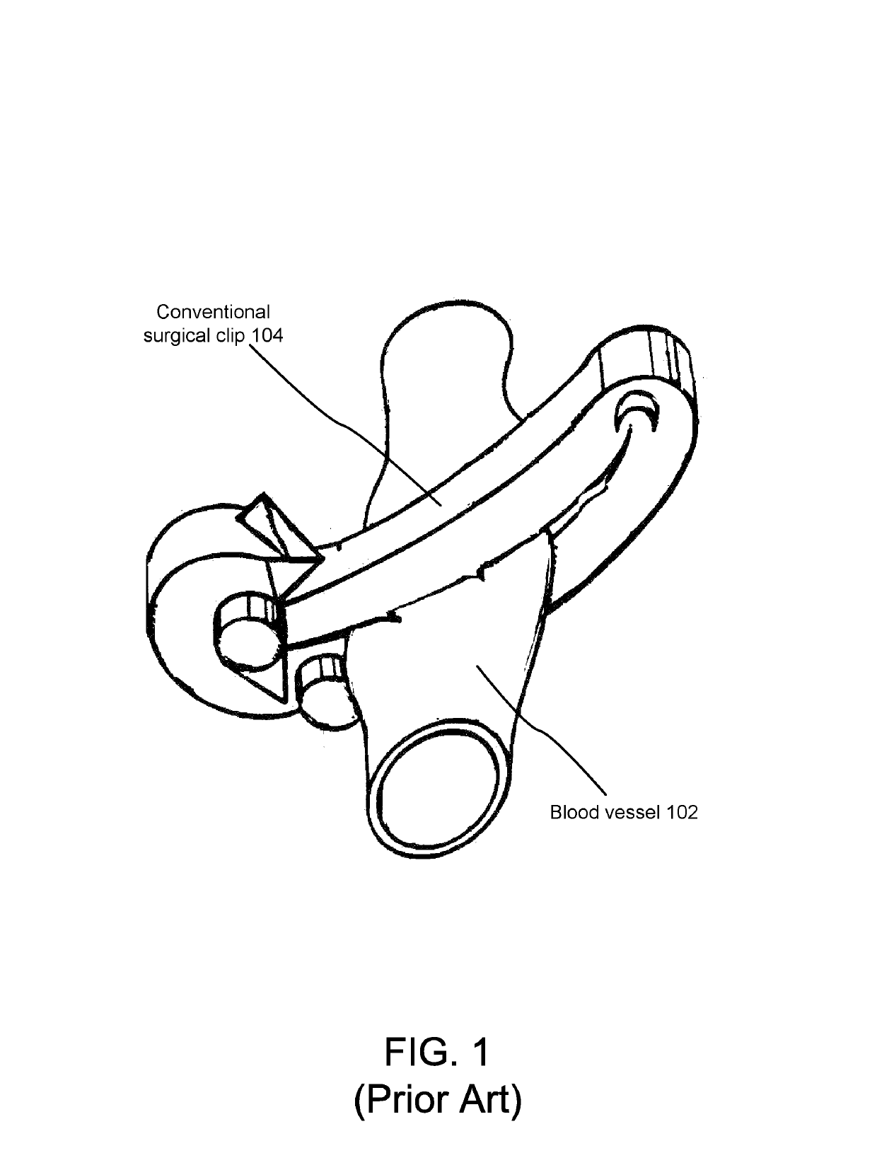 Surgical ligation clip