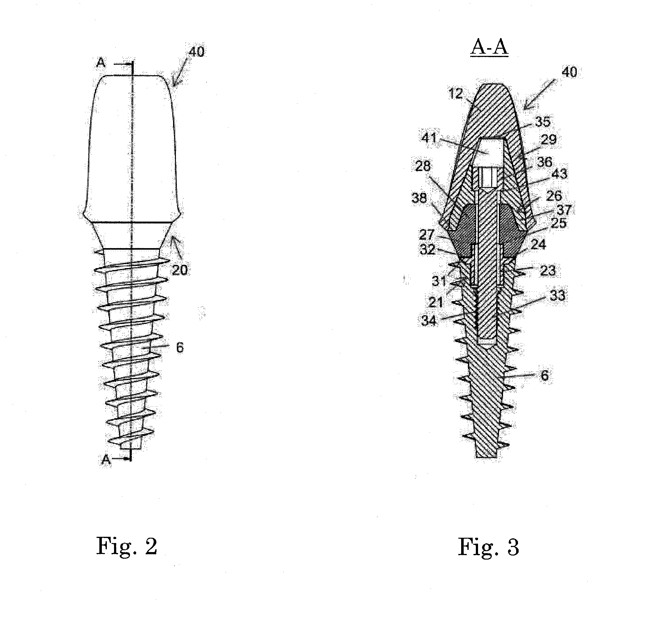 Abutment assembly for dental implants