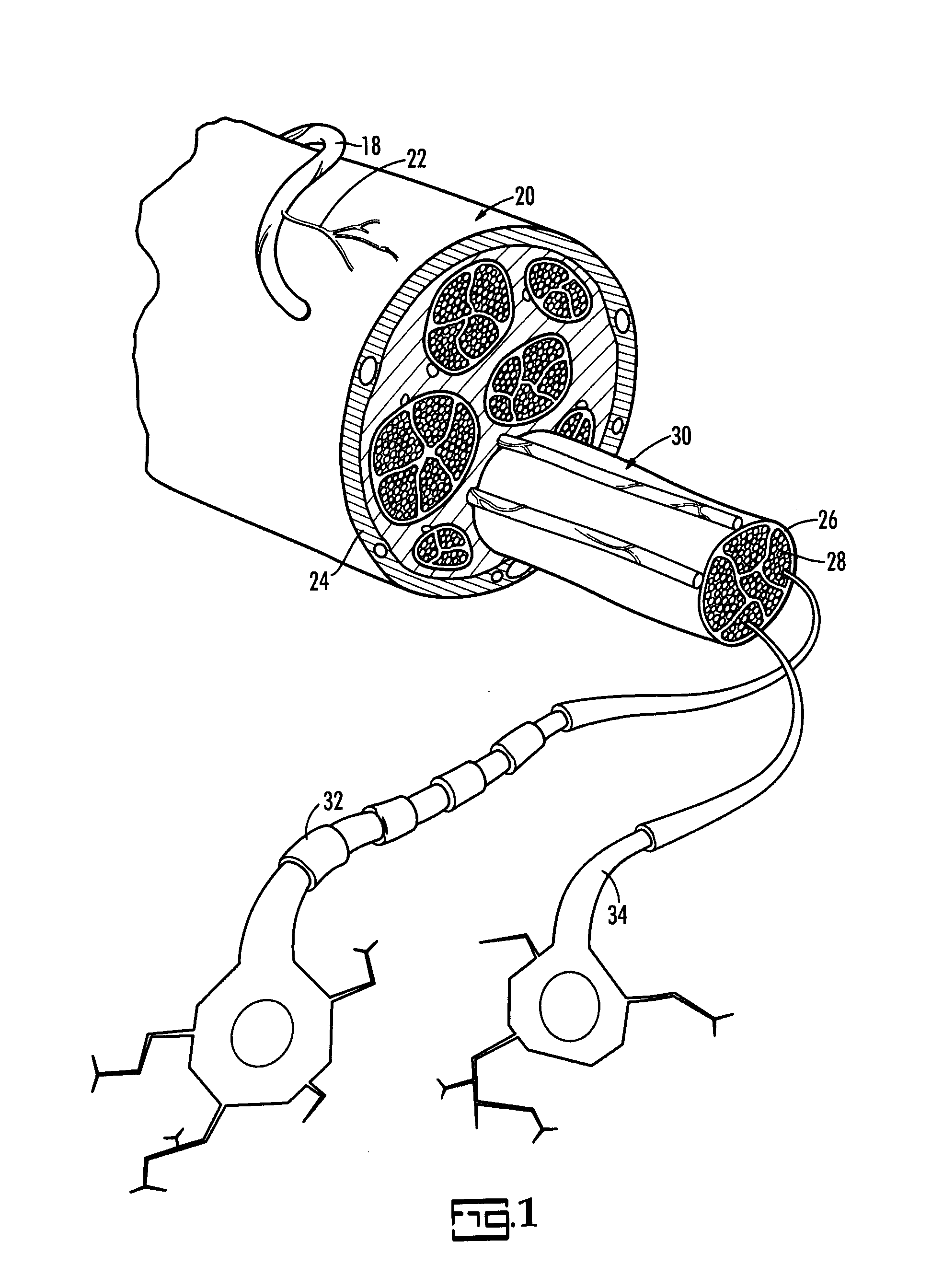 Intraneural Facilitation