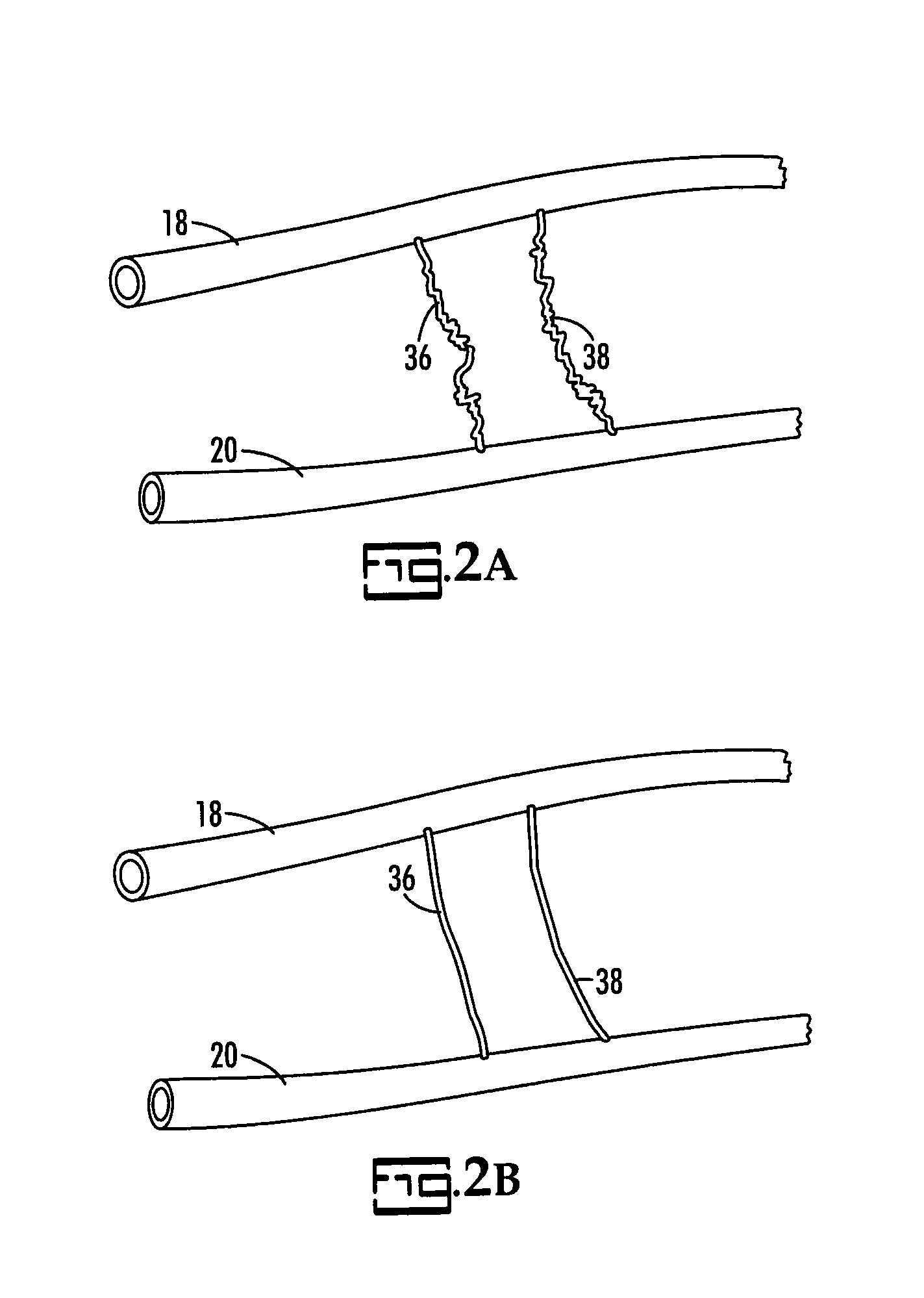 Intraneural Facilitation