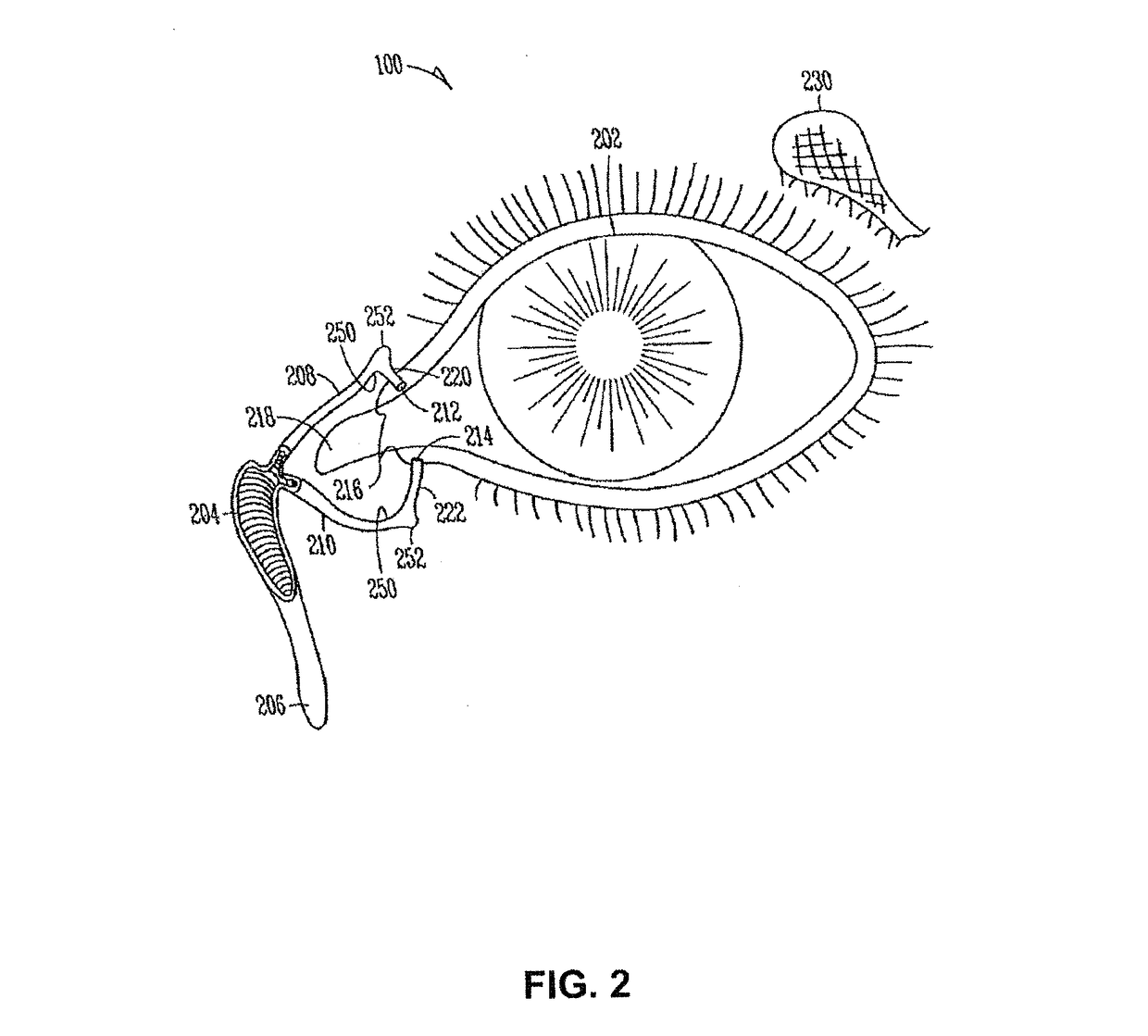 Drug delivery system and methods of treating open angle glaucoma and ocular hypertension