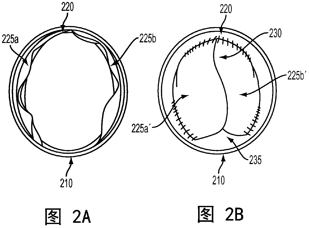 Expandable Implantable Catheter