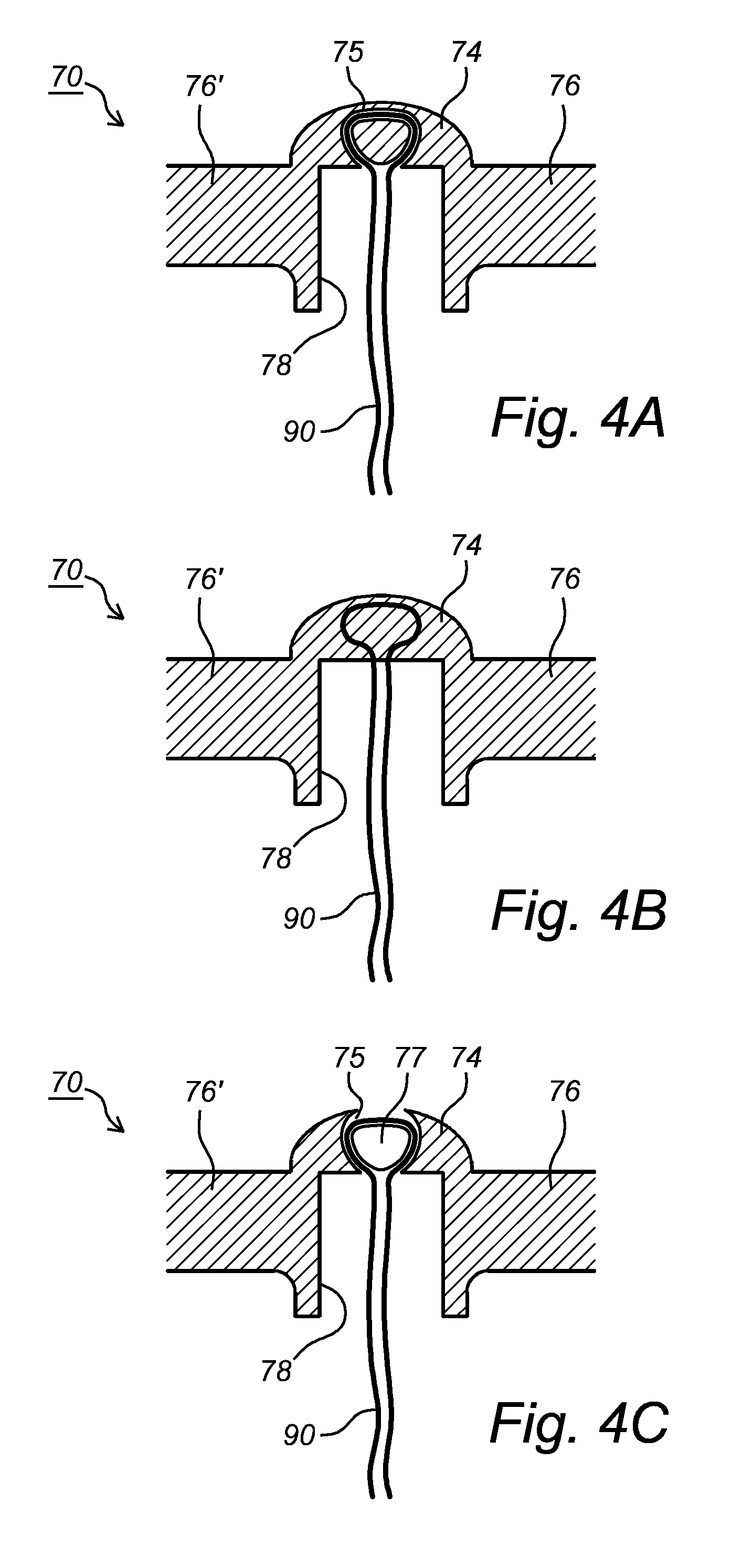 Intrauterine Device