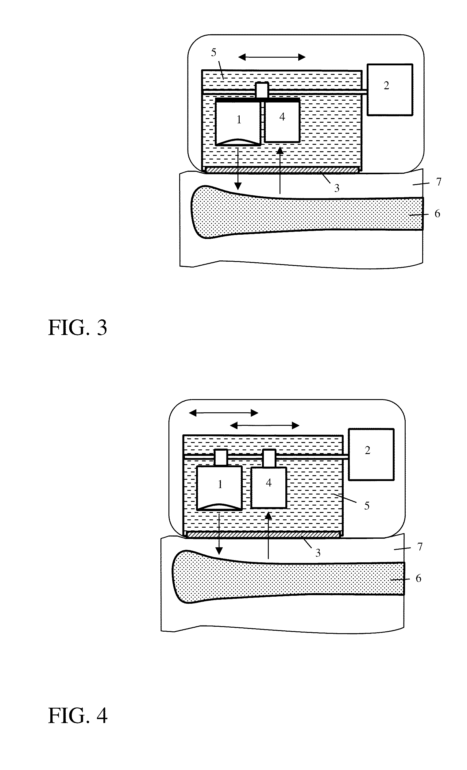 Ultrasonometer for bone assessment in infants