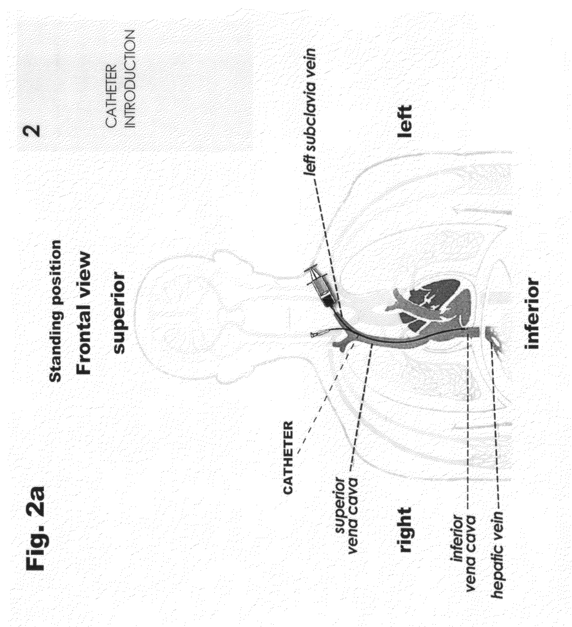 Method and a catheter device for the dynamic regulation of the venous return to the heart for the treatment of patients with heart failure