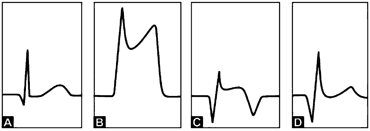 Electrocardiosignal ST section automatic judging method and device based on artificial intelligent technology