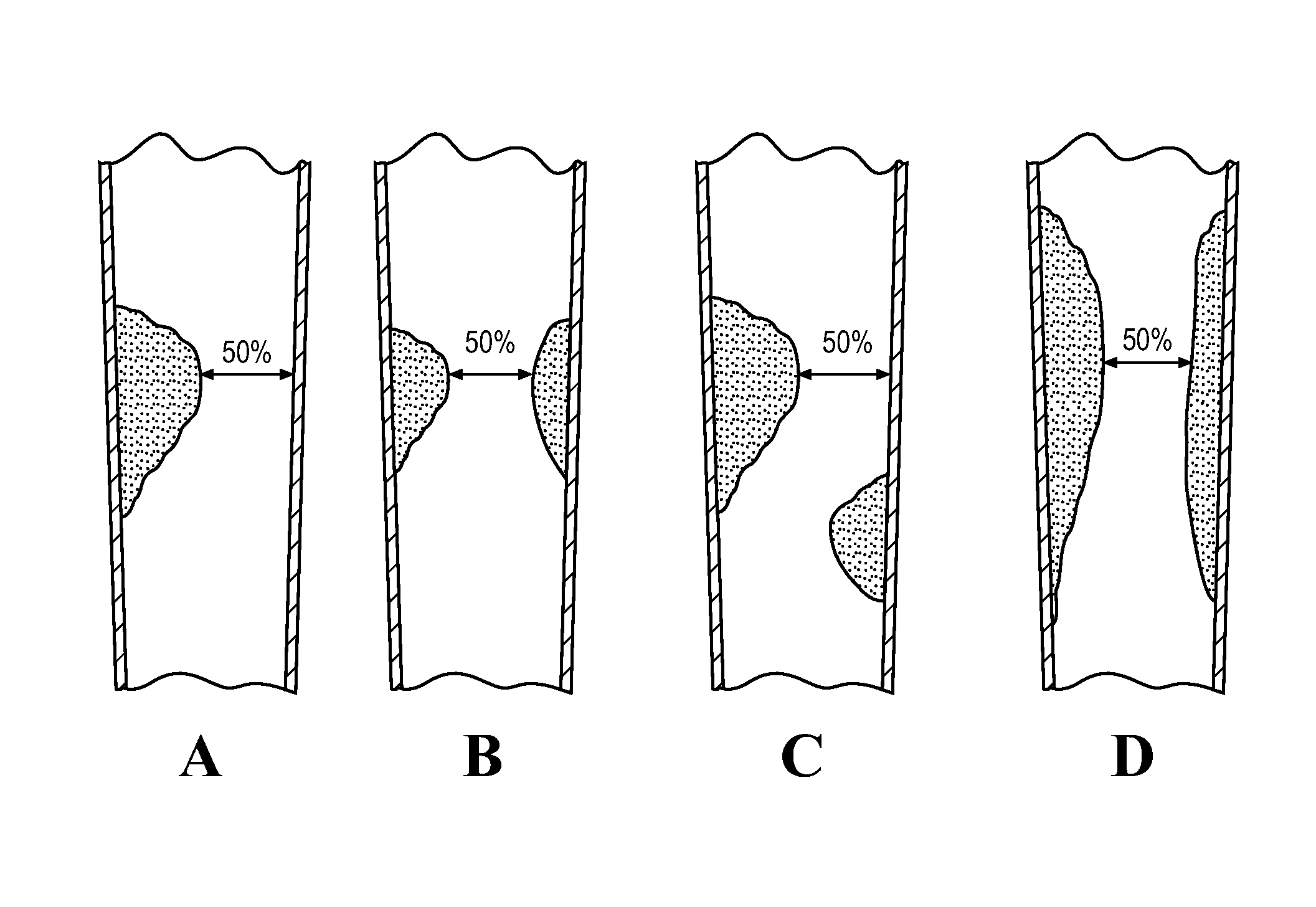 Method for assessing stenosis severity through stenosis mapping