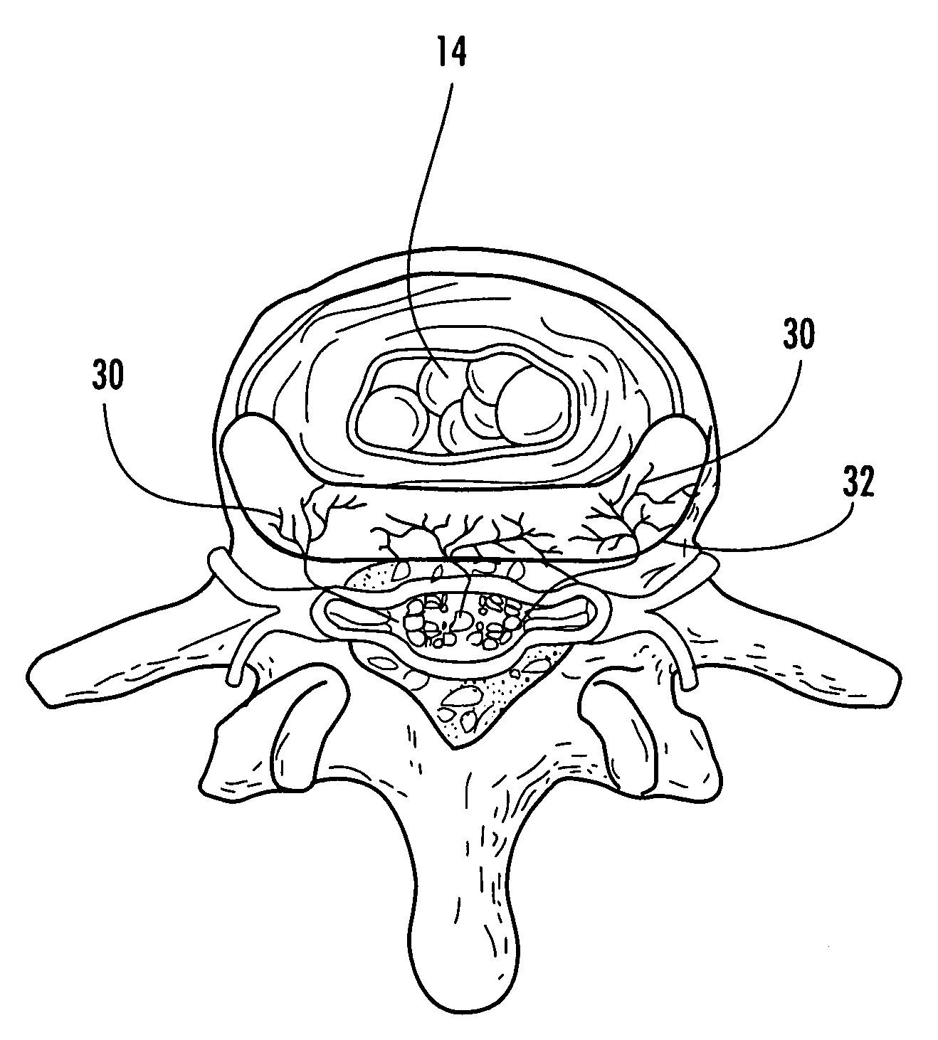 Method and apparatus for treatment of discogenic pain