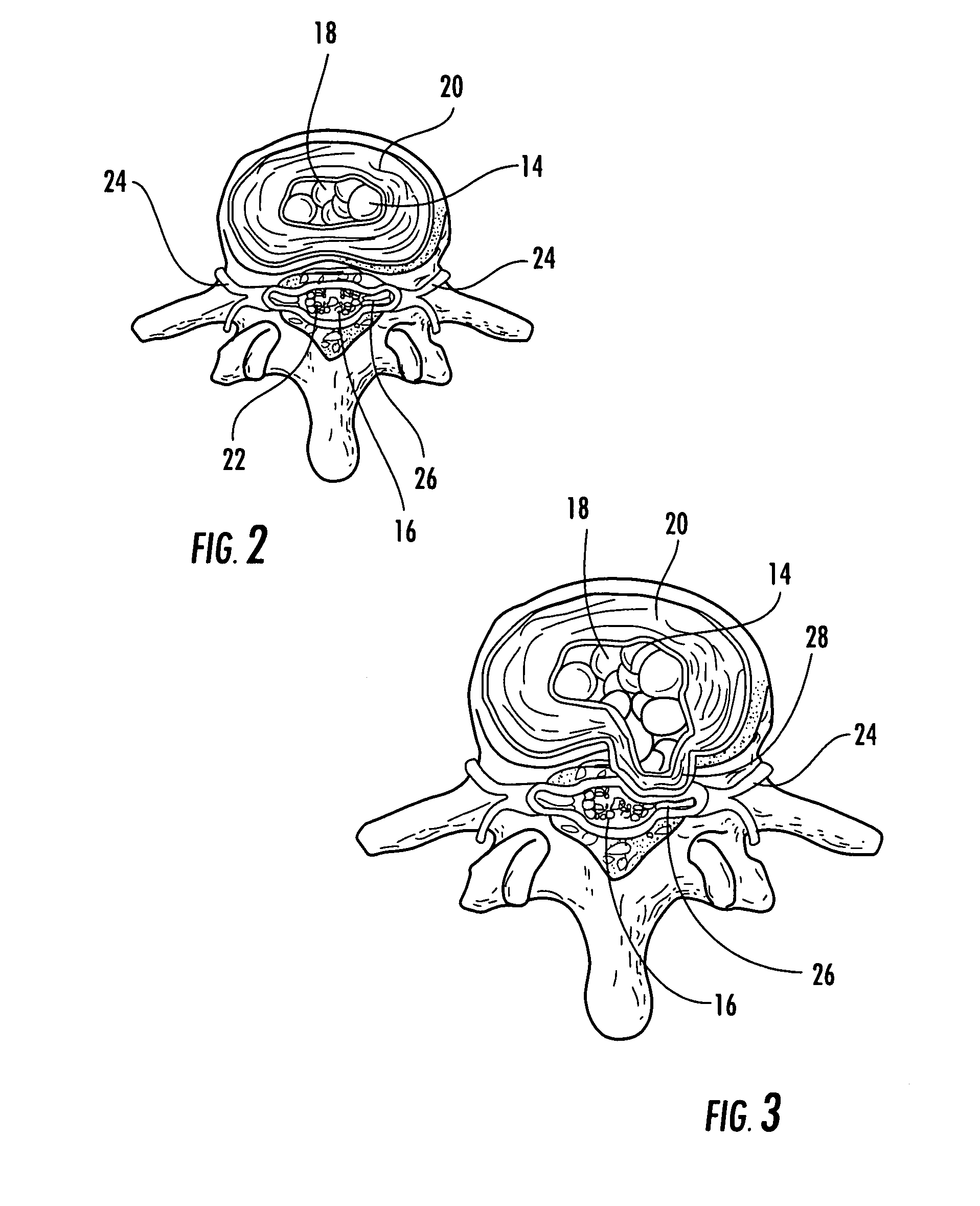 Method and apparatus for treatment of discogenic pain