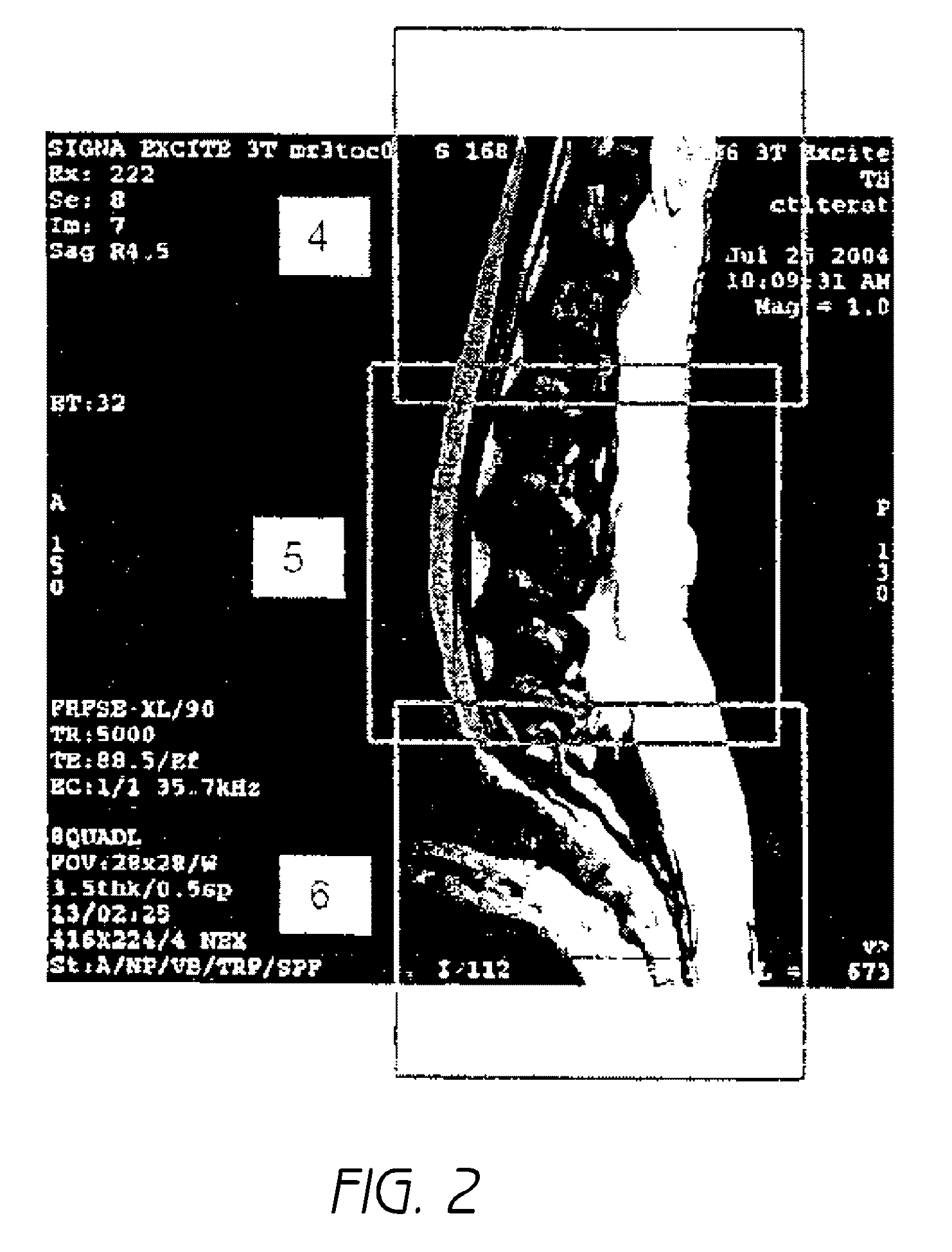 MR spectroscopy system and method for diagnosing painful and non-painful  intervertebral discs