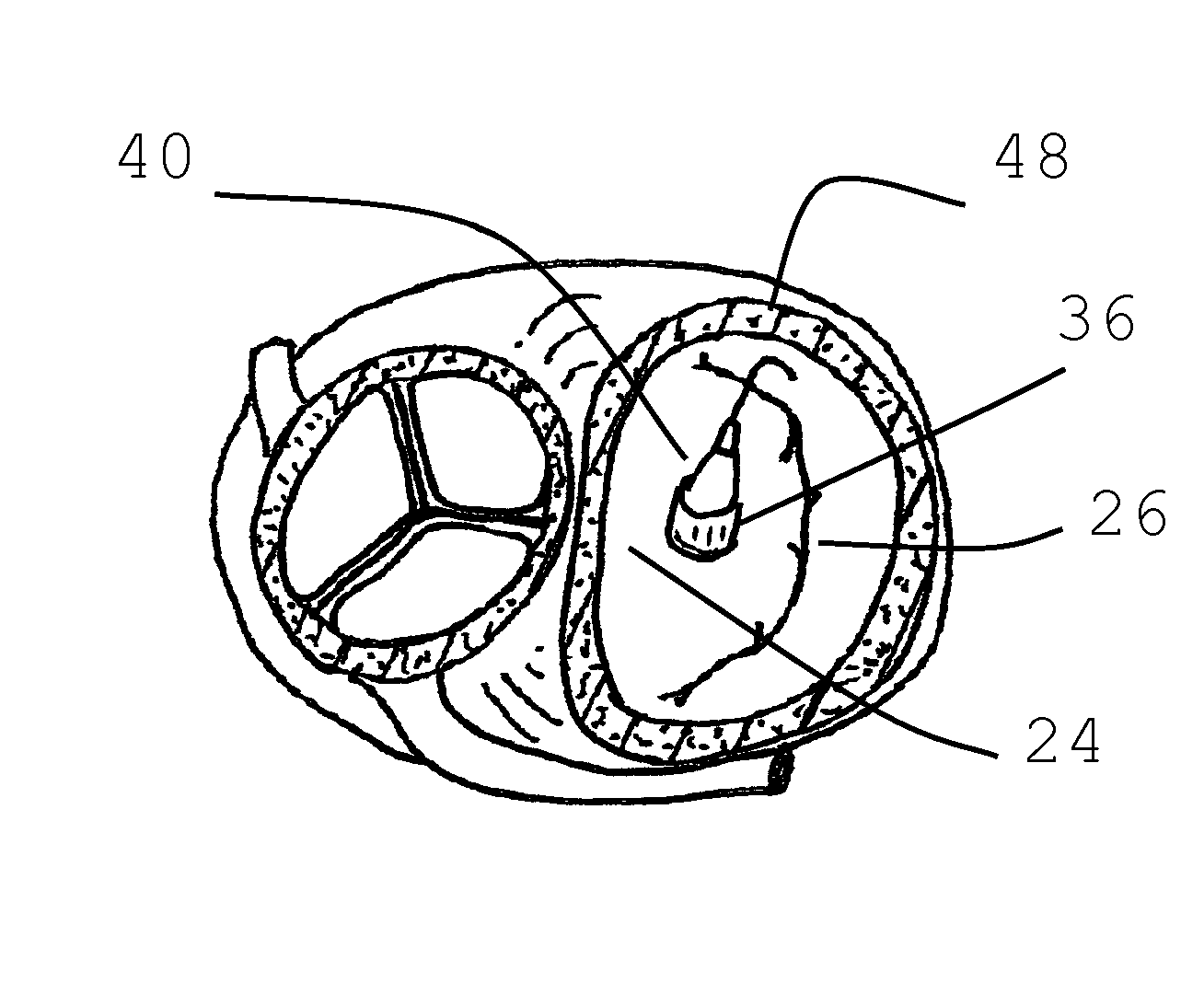 Method for implanting prosthetic valve