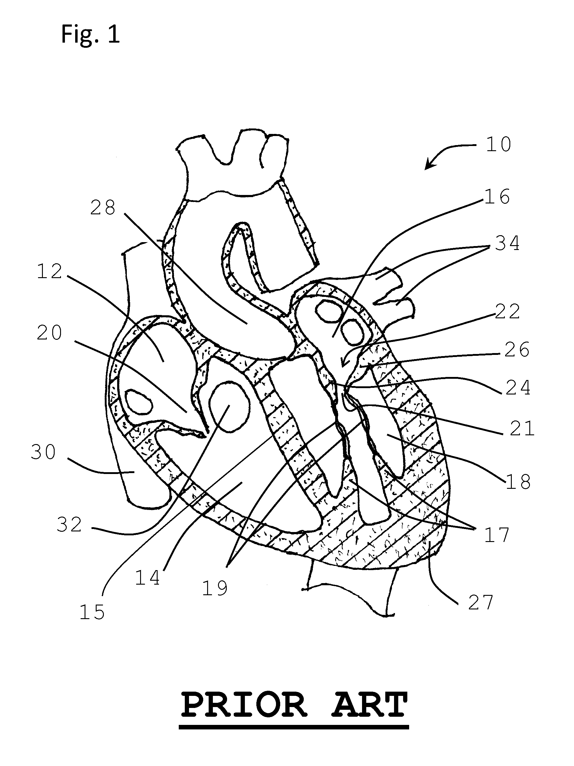 Method for implanting prosthetic valve