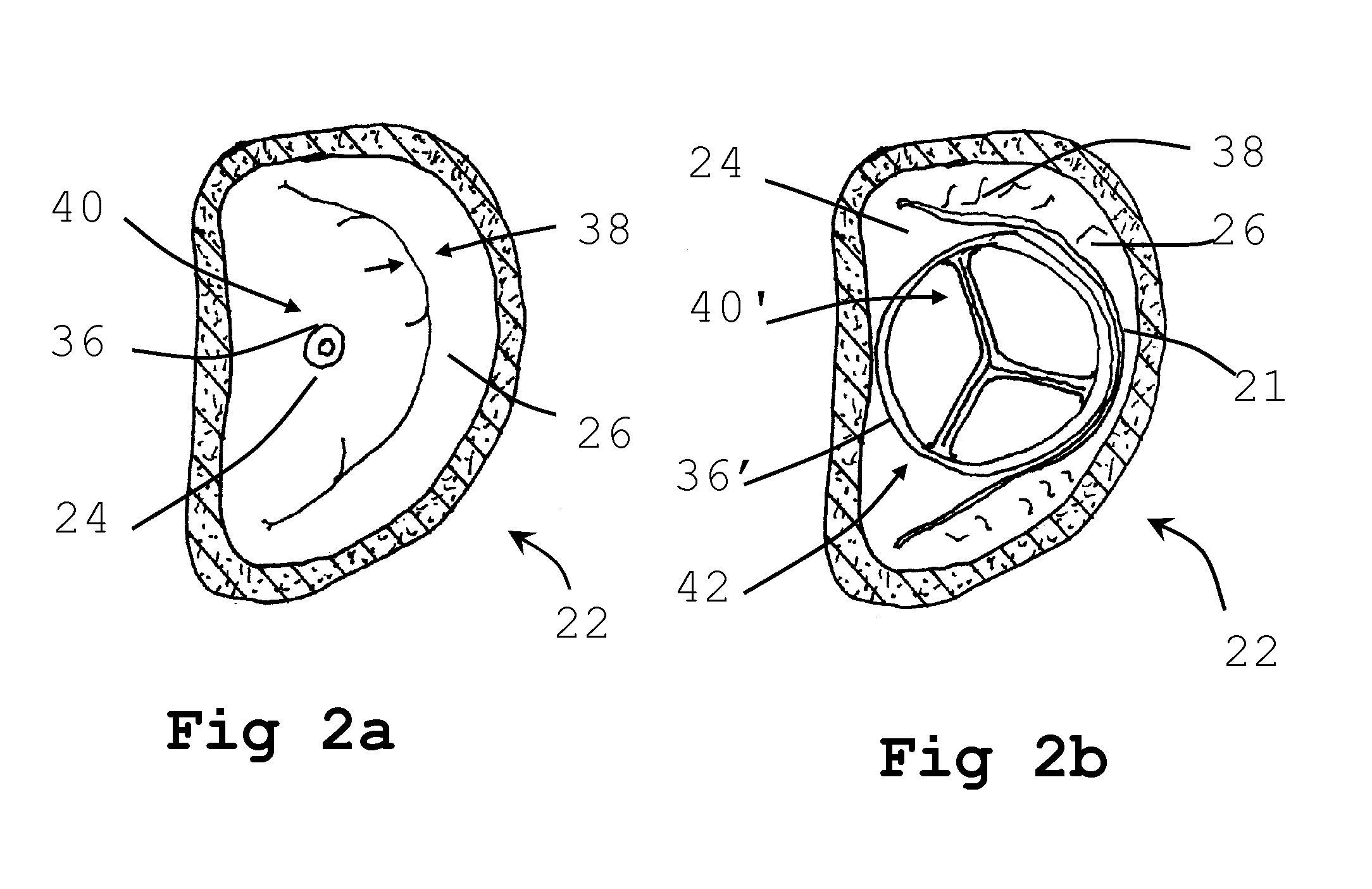 Method for implanting prosthetic valve