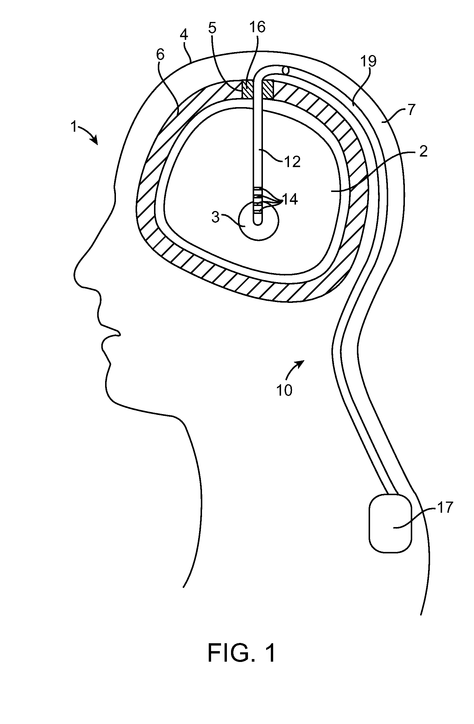 Burr hole plug having dual slidable clamping mechanisms